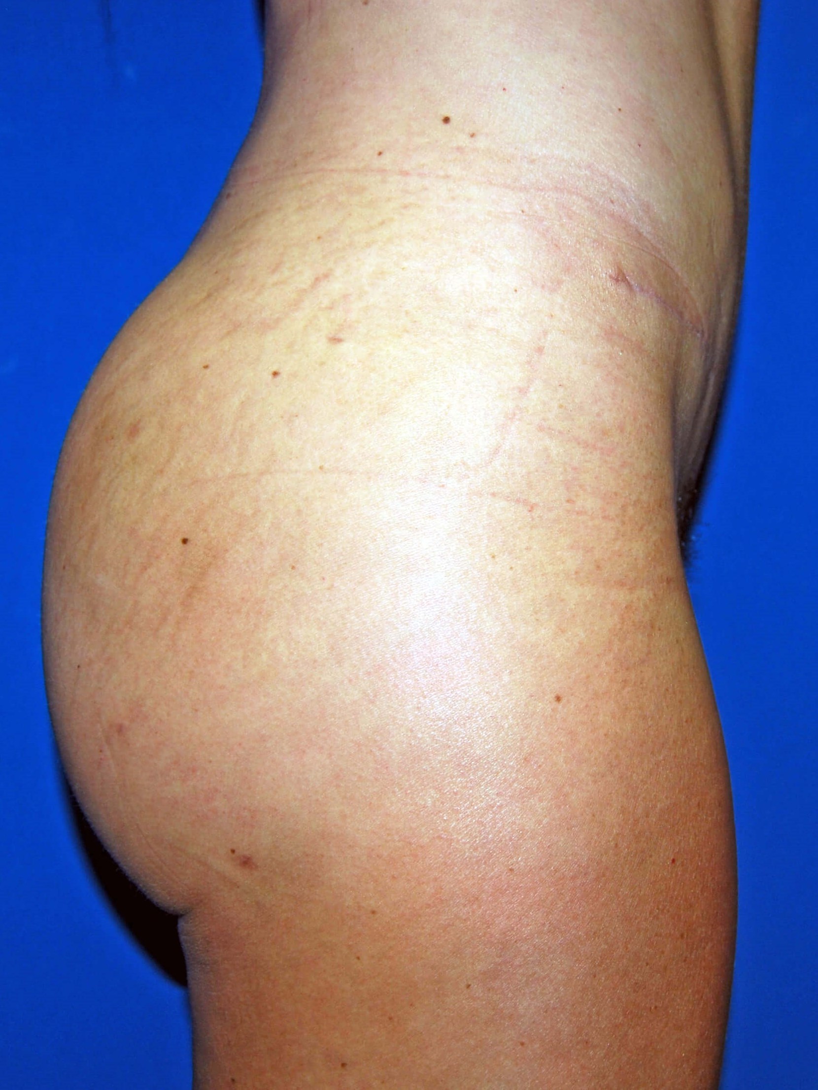 Lateral After BBL