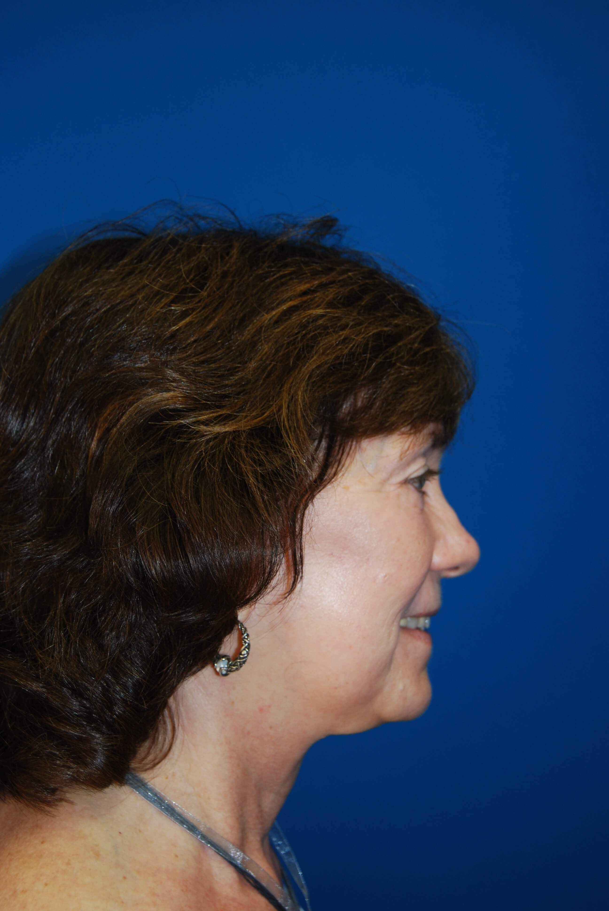 Lateral After