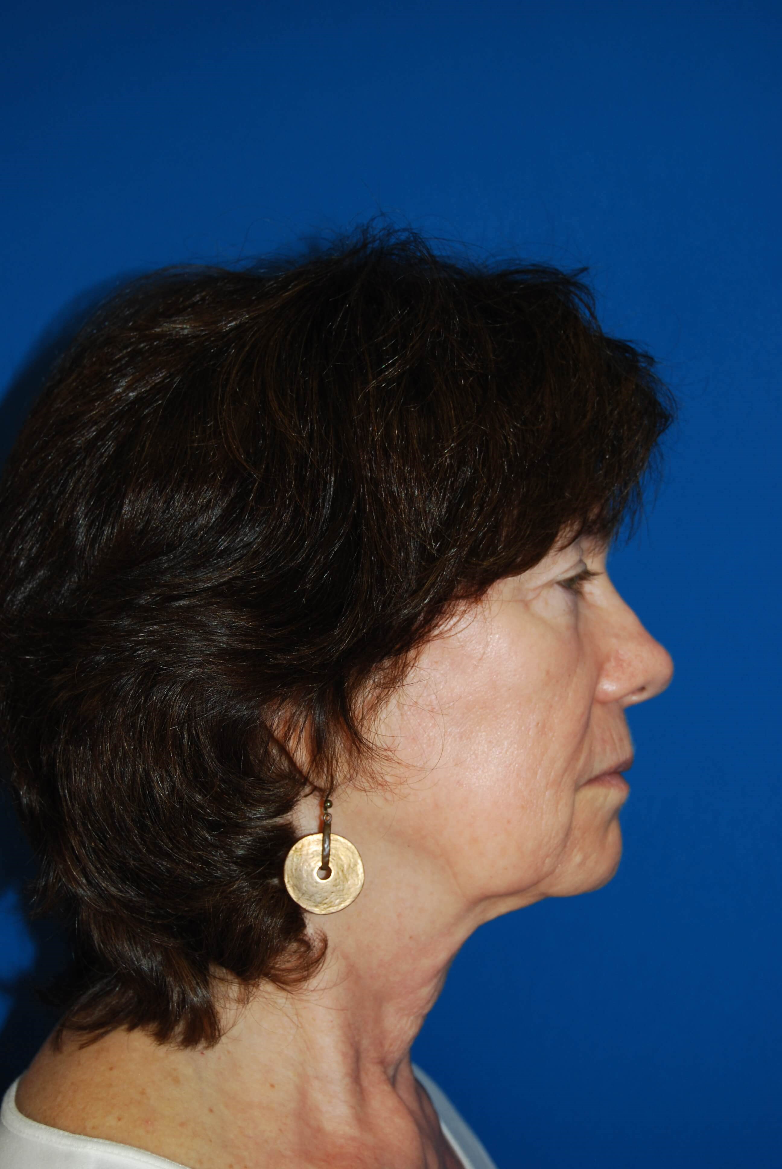 Lateral Before