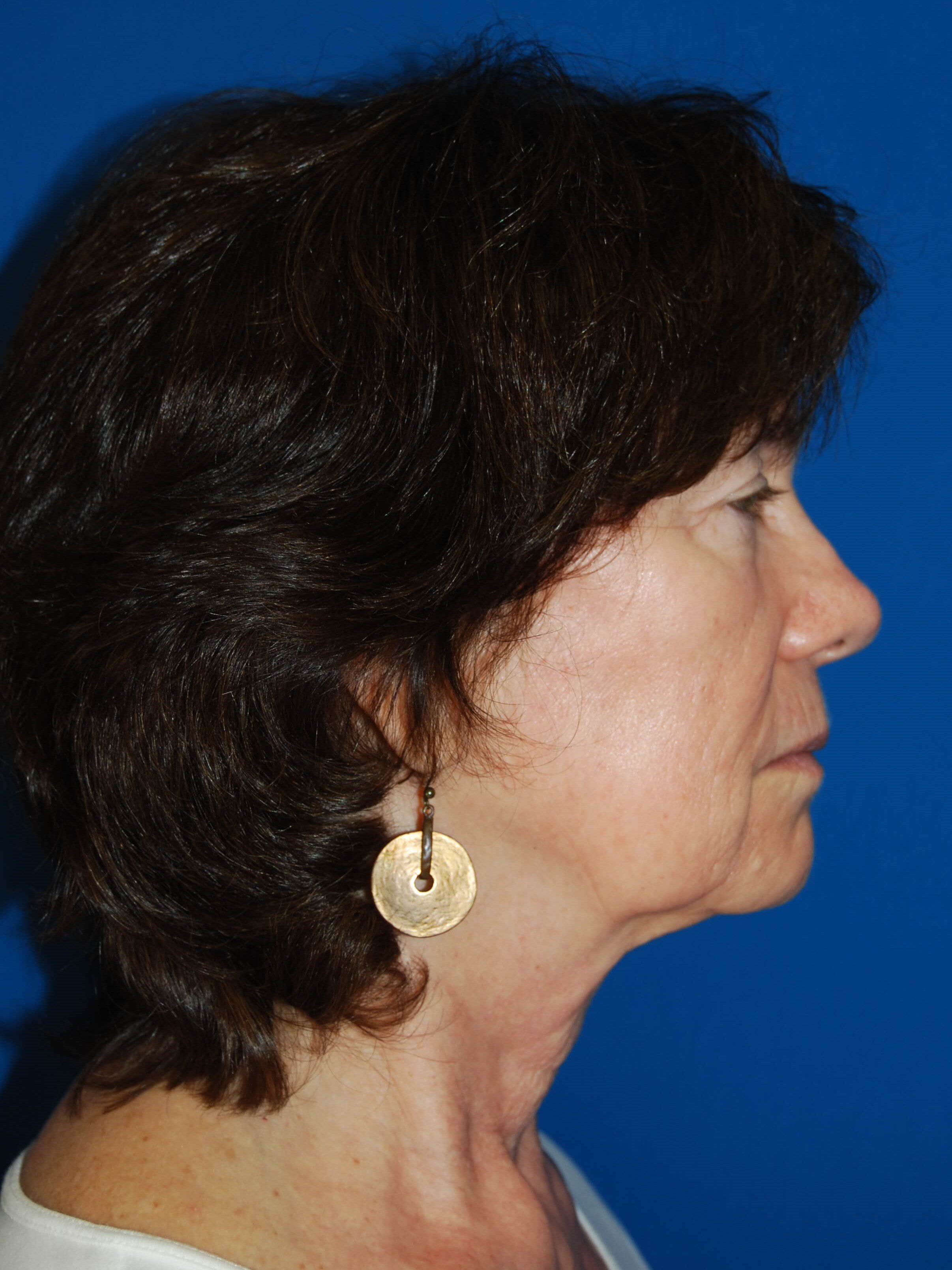 Lateral Before