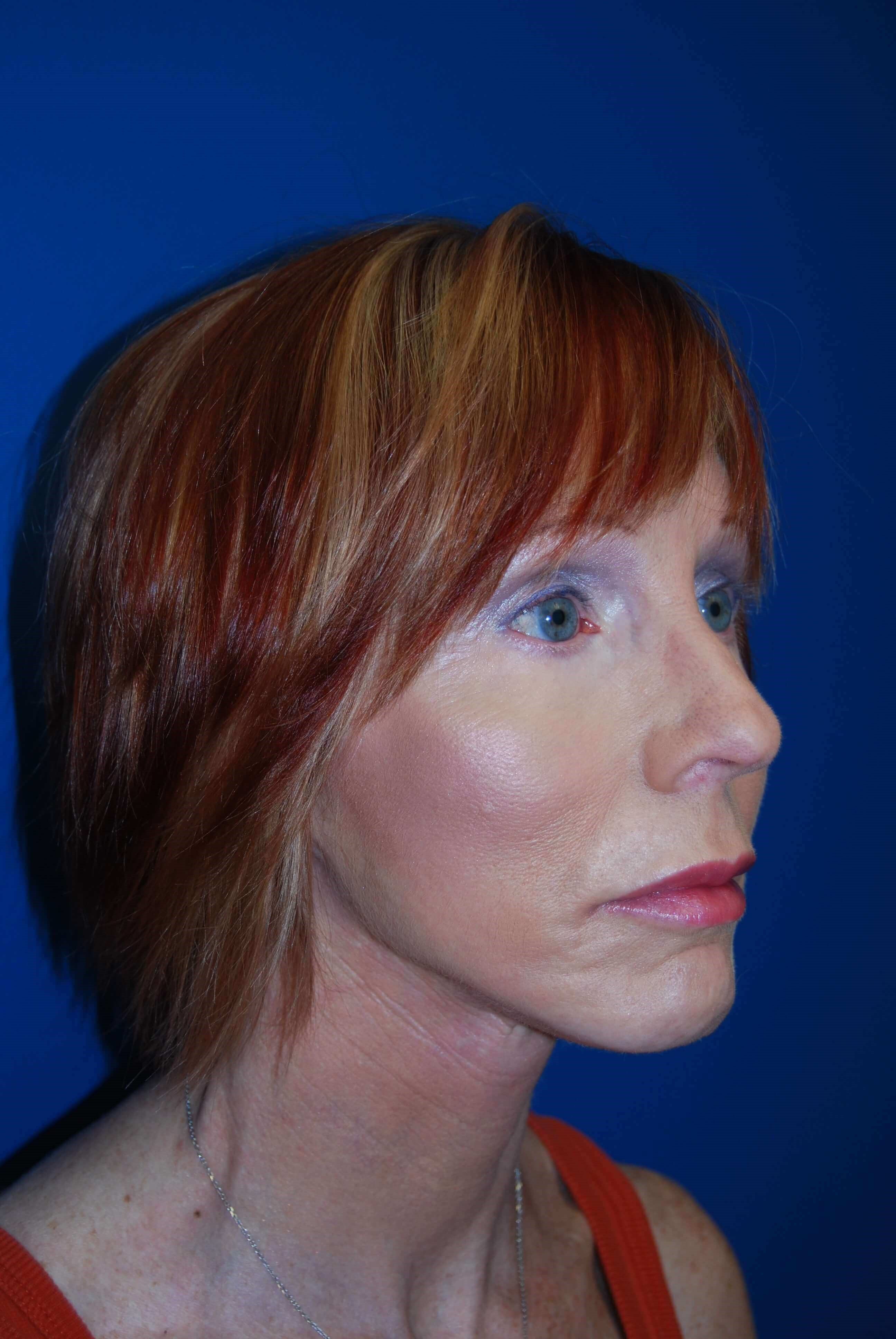 Oblique - Right After