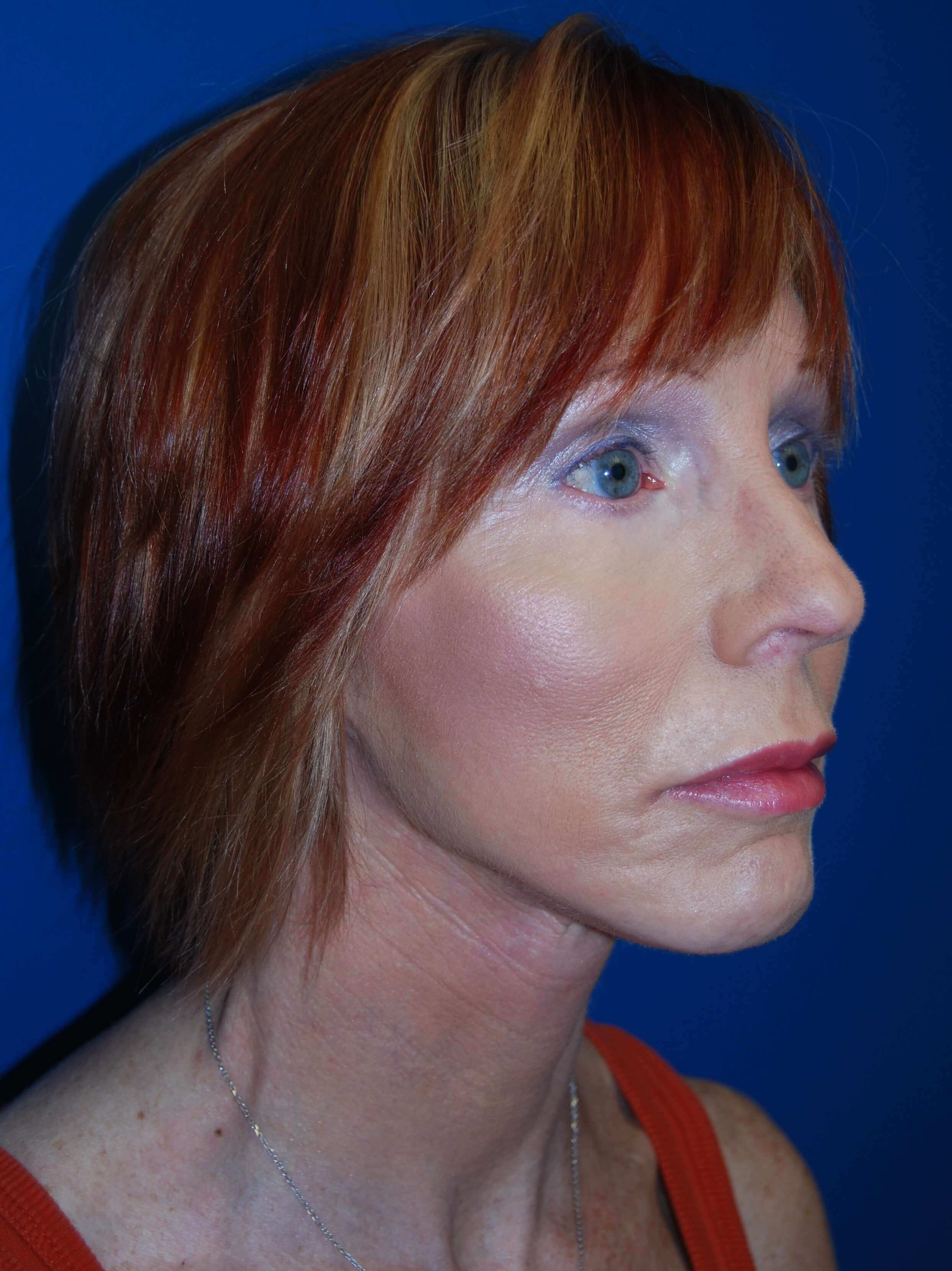 Oblique - Right After