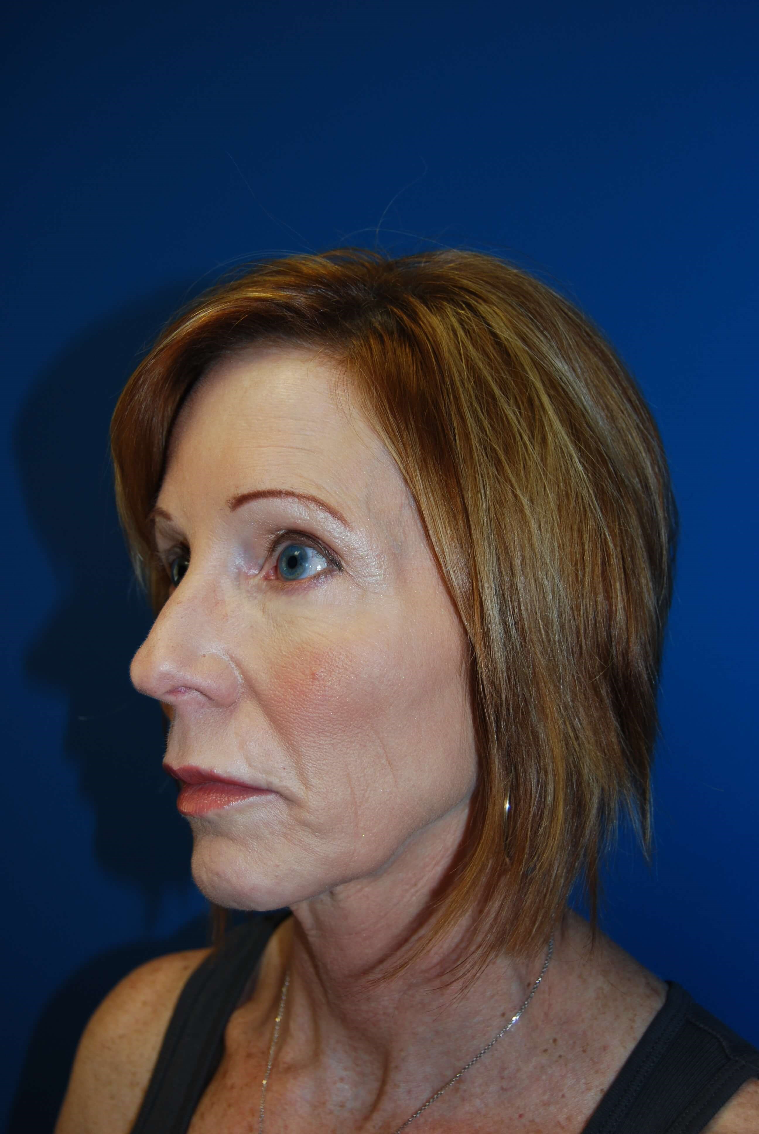 Oblique - Left Before