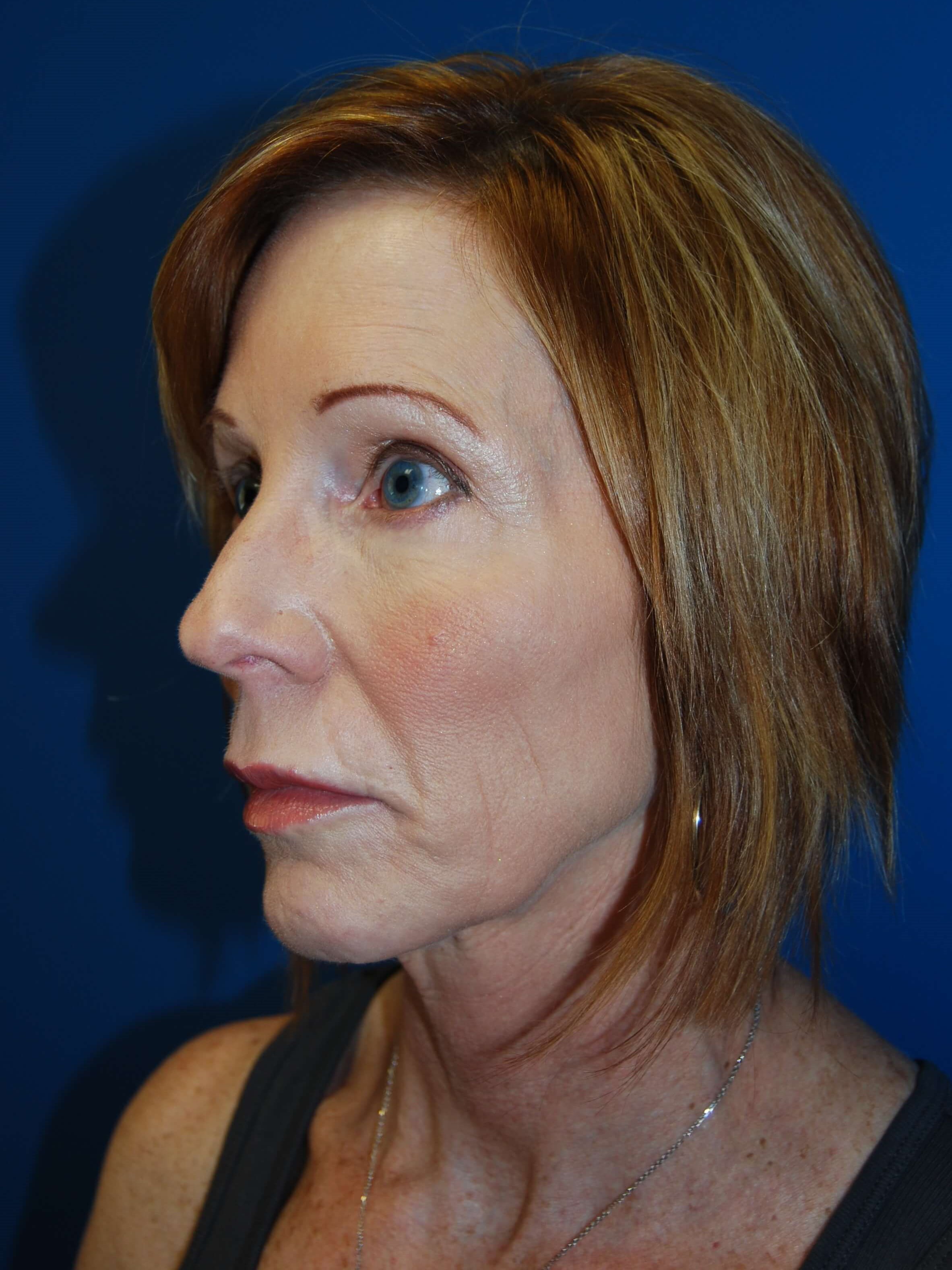 Oblique - Left Before