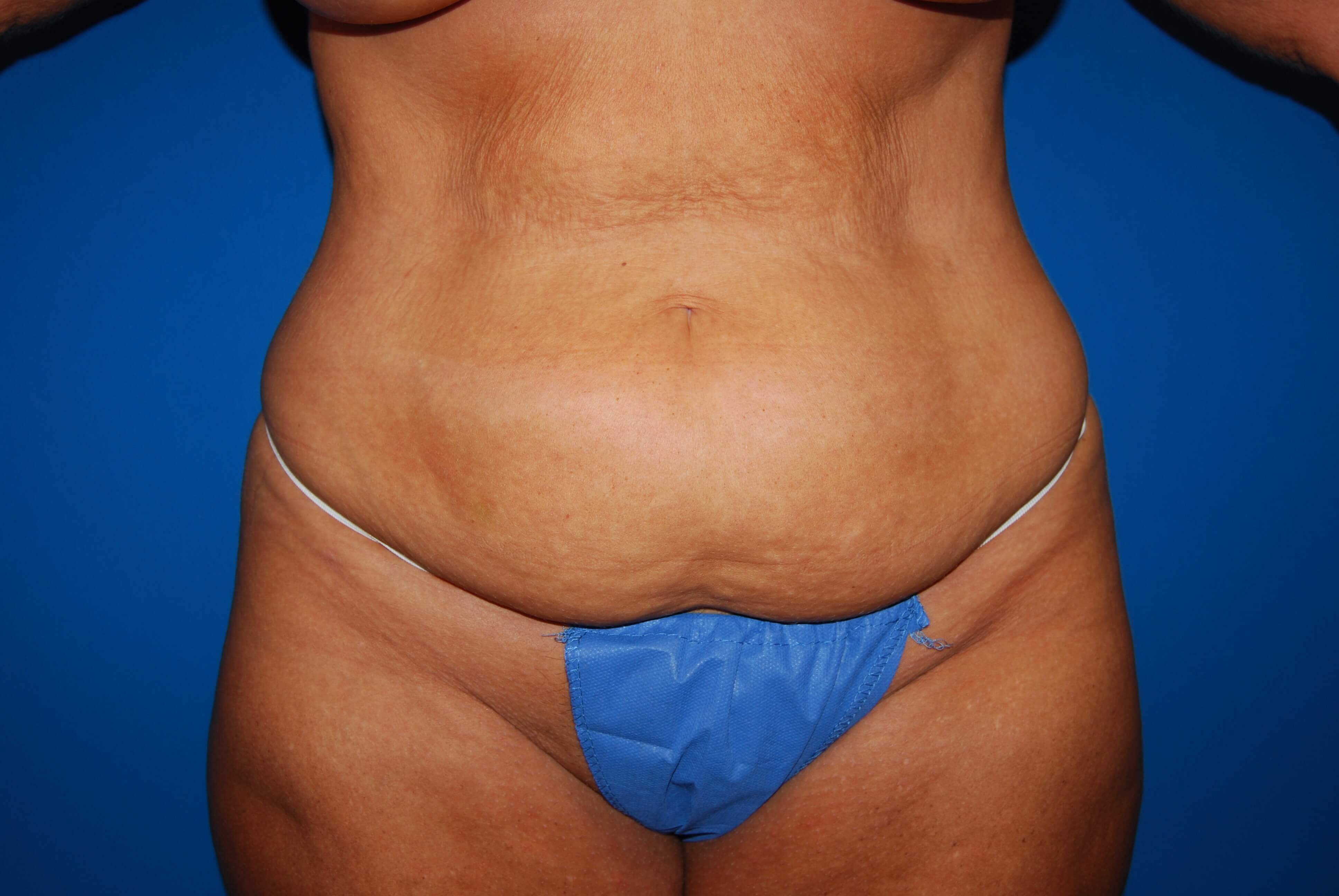 Front Before Tummy Tuck