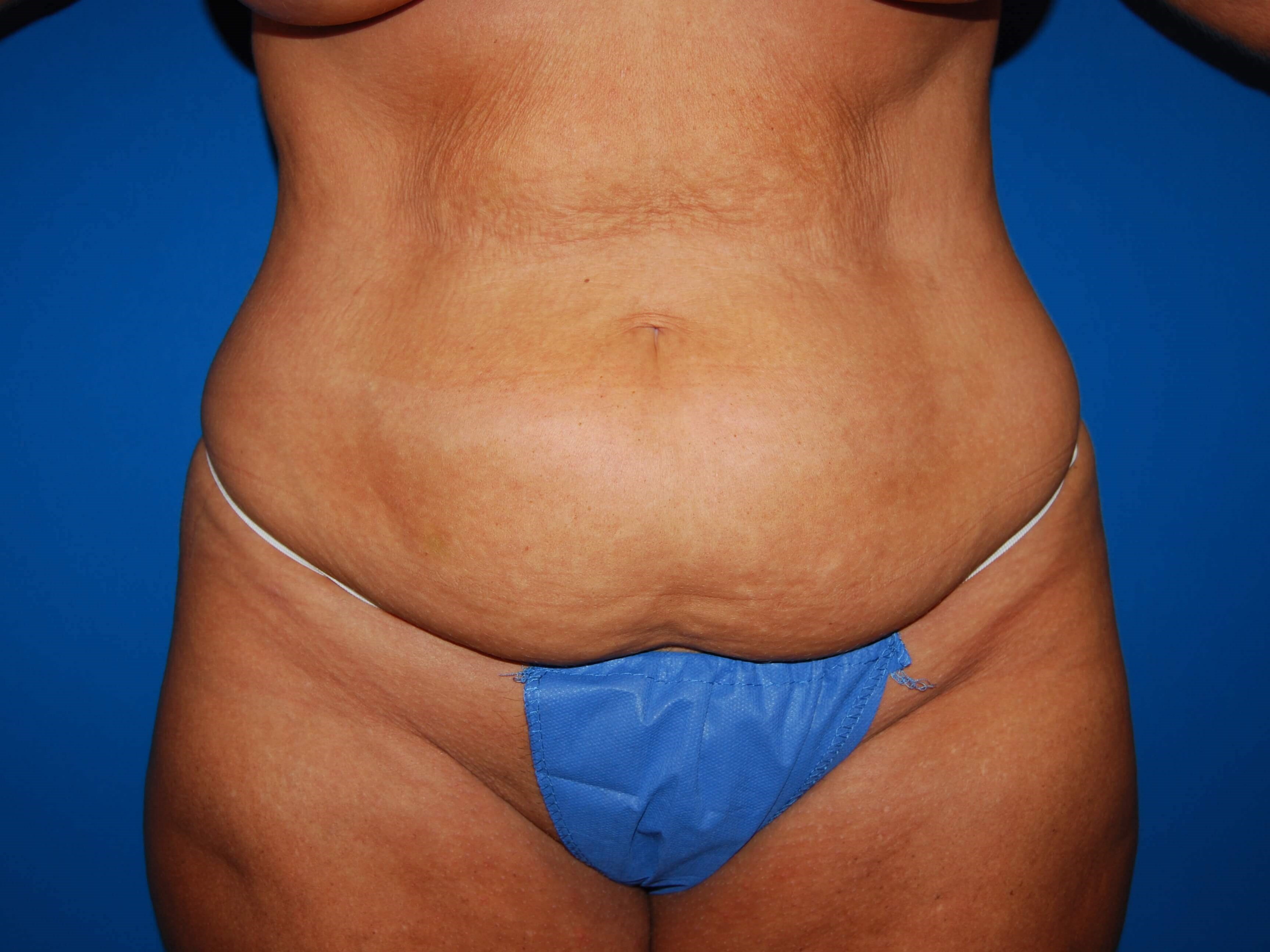 Front Before Tummy Tuck