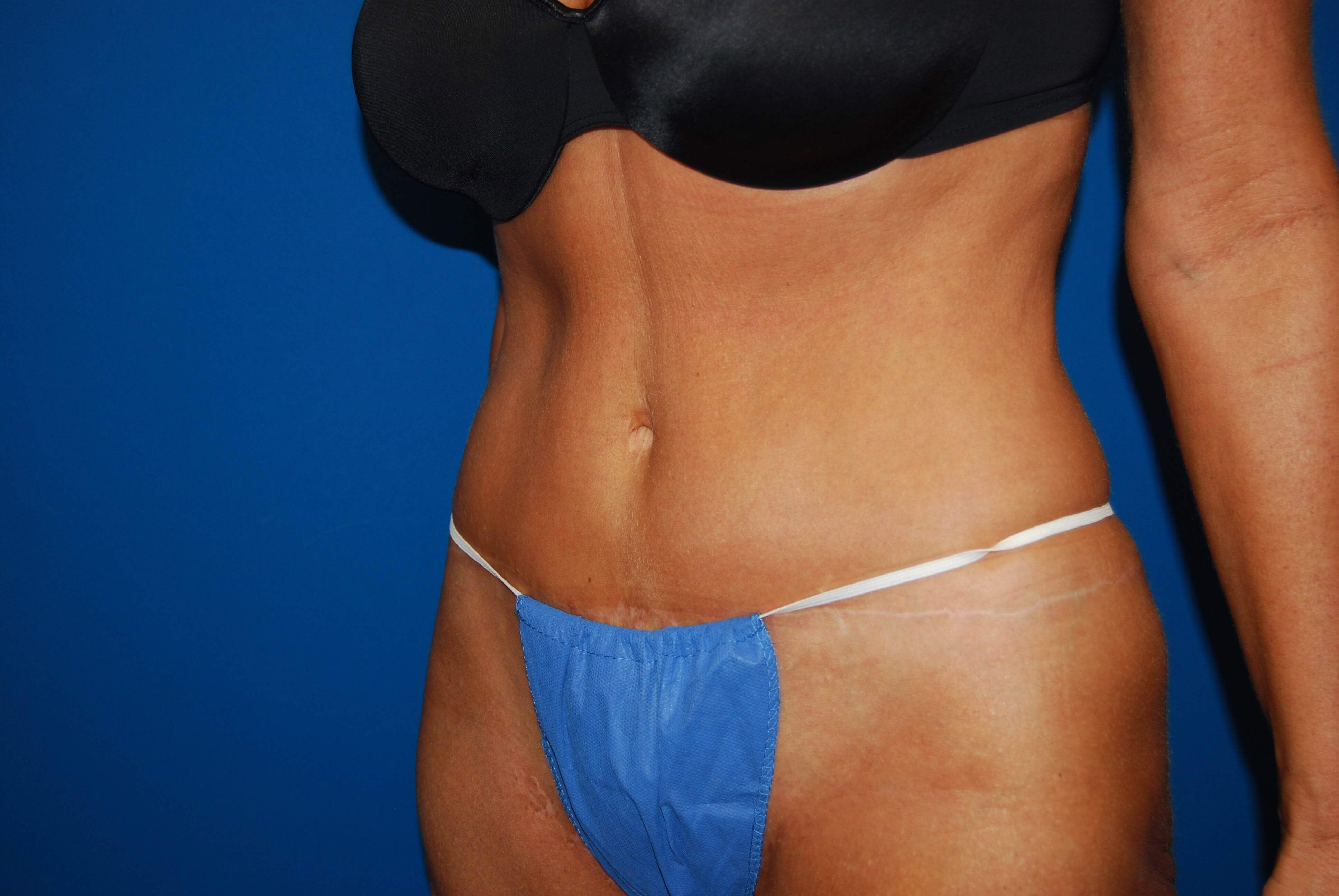 Left After Tummy Tuck