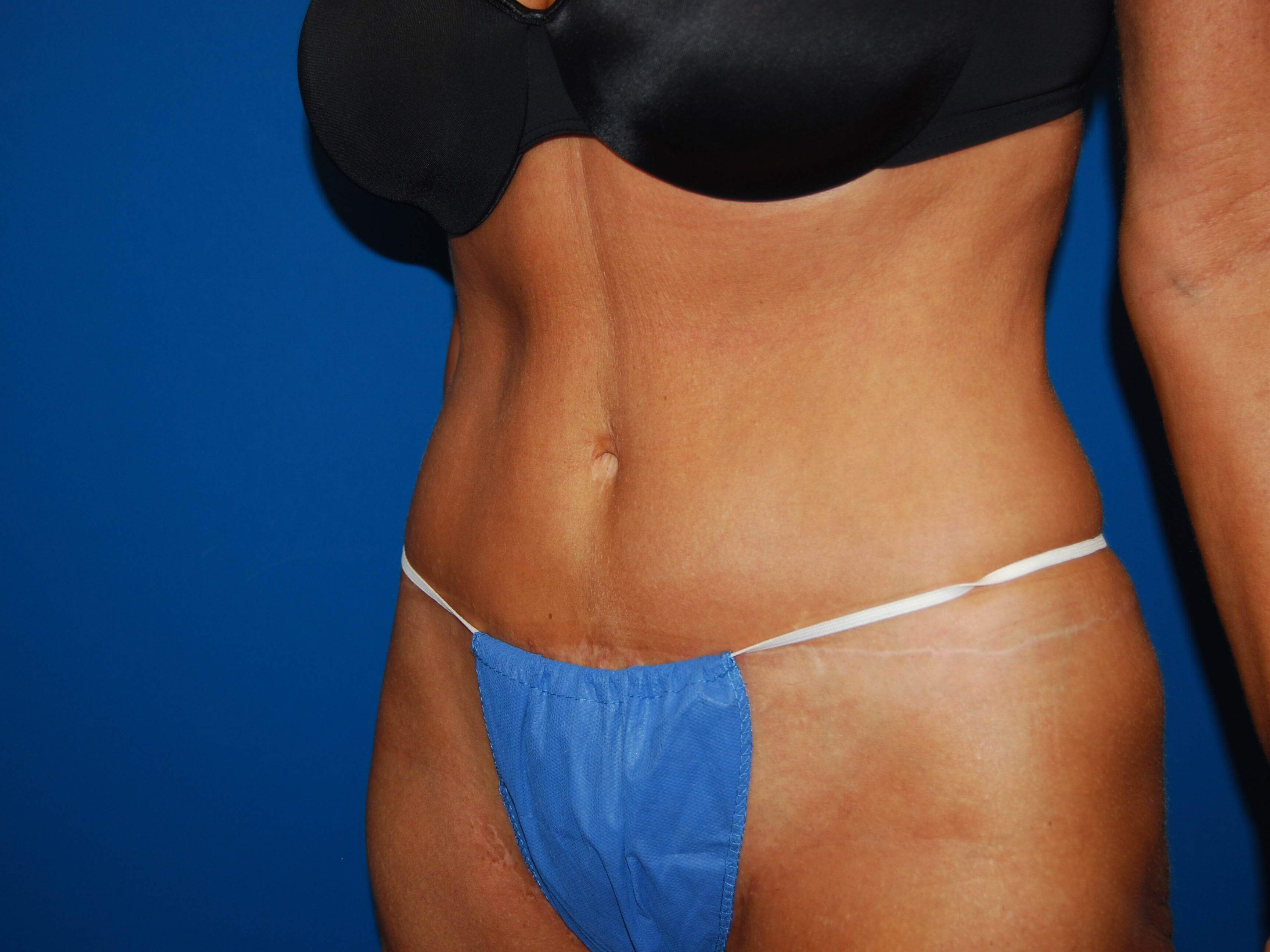 Left After Tummy Tuck