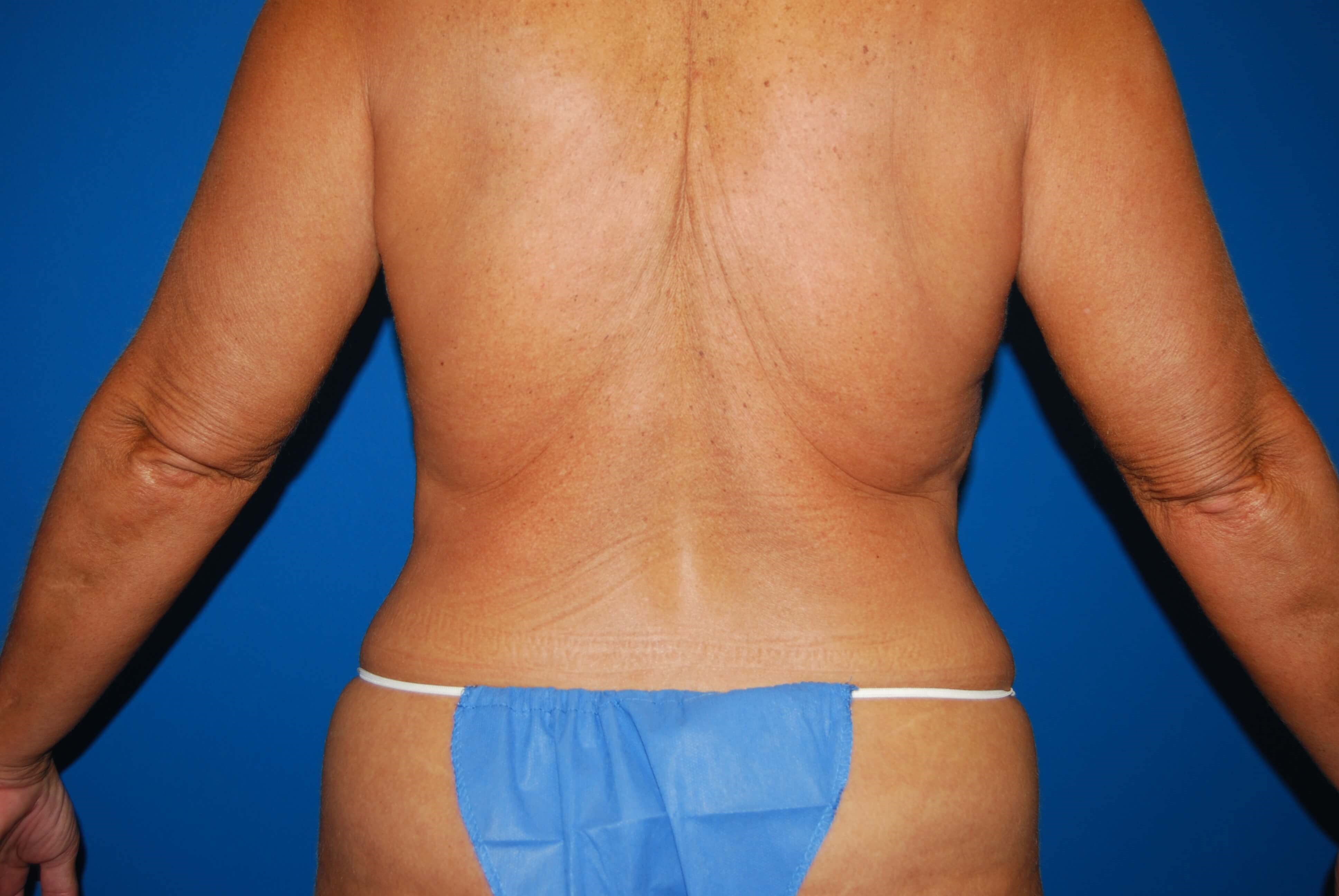 Back Before Tummy Tuck