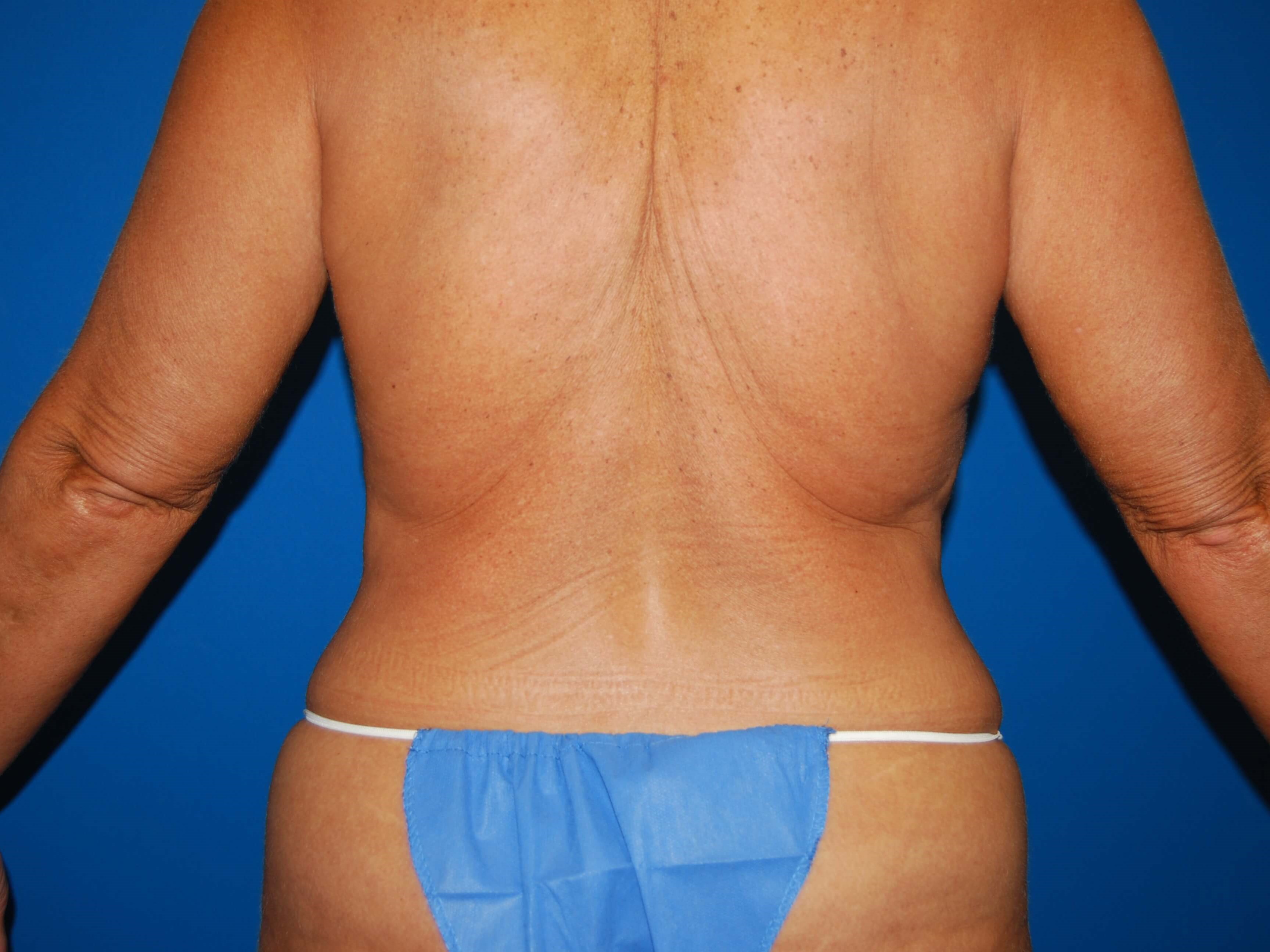 Back Before Tummy Tuck