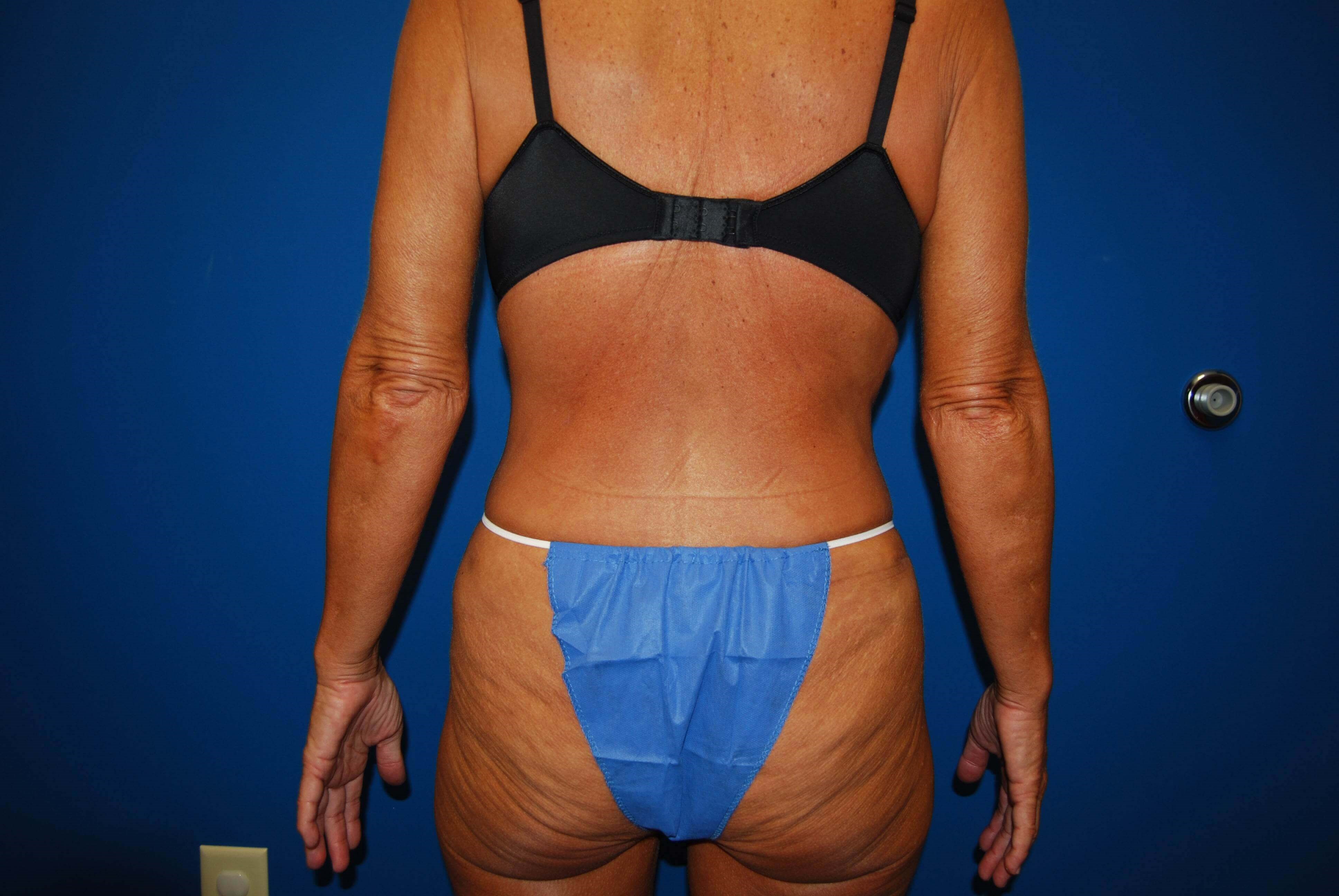 Back After Tummy Tuck