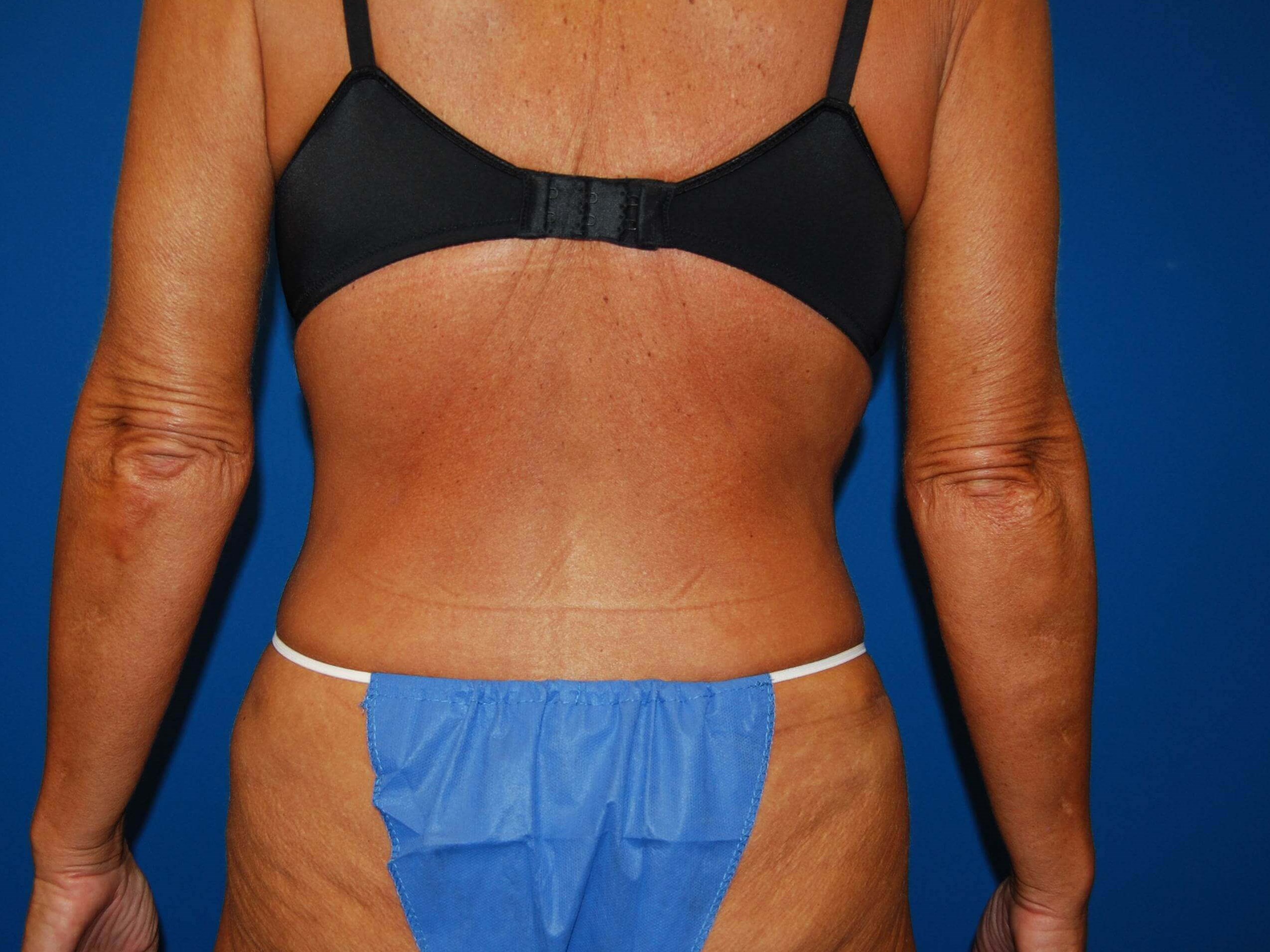 Back After Tummy Tuck