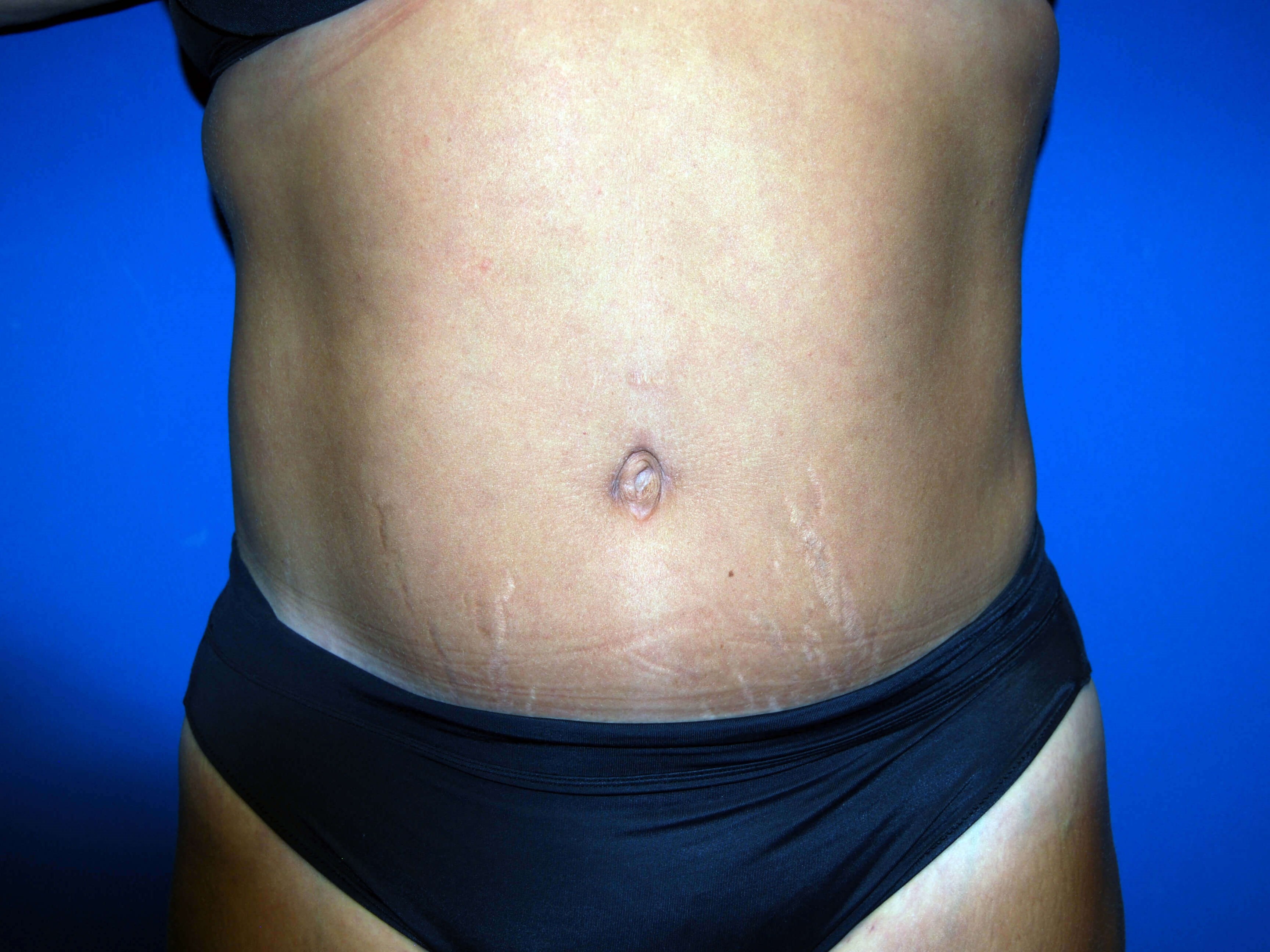 Front After Abdominoplasty