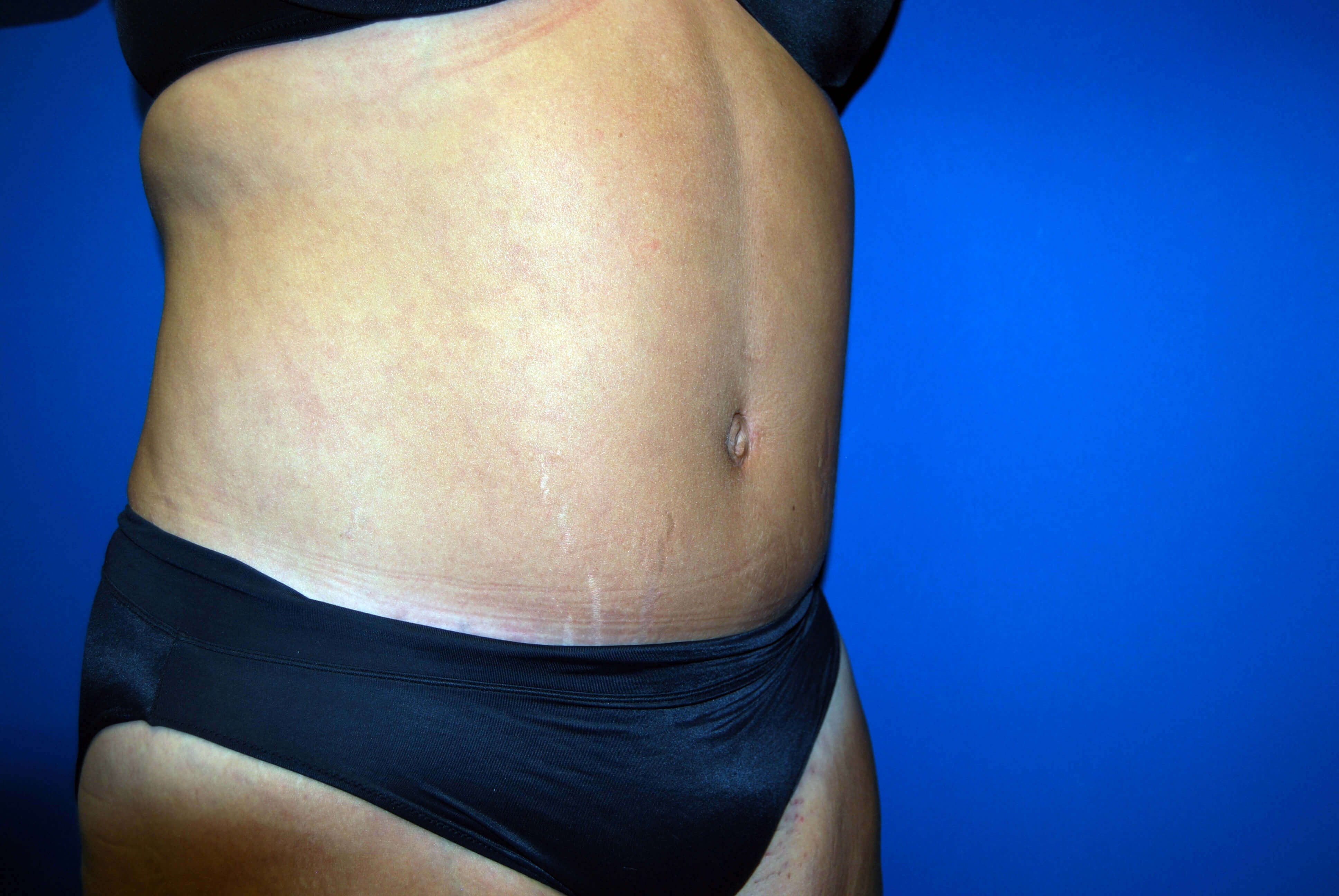 Right After Abdominoplasty