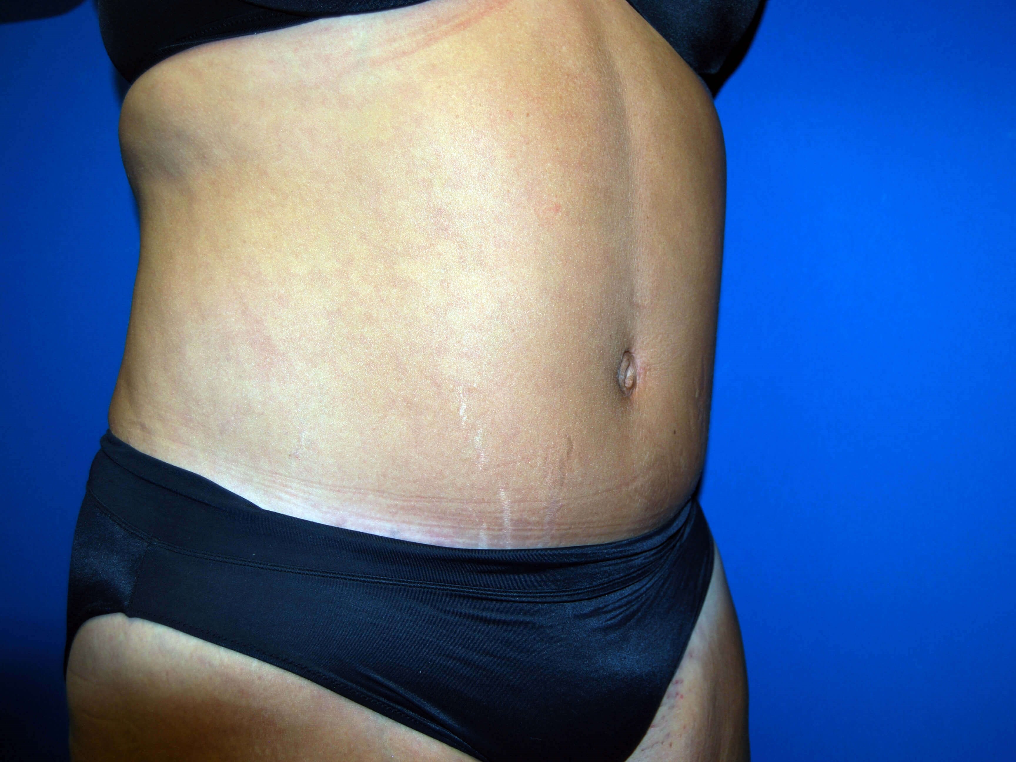 Right After Abdominoplasty