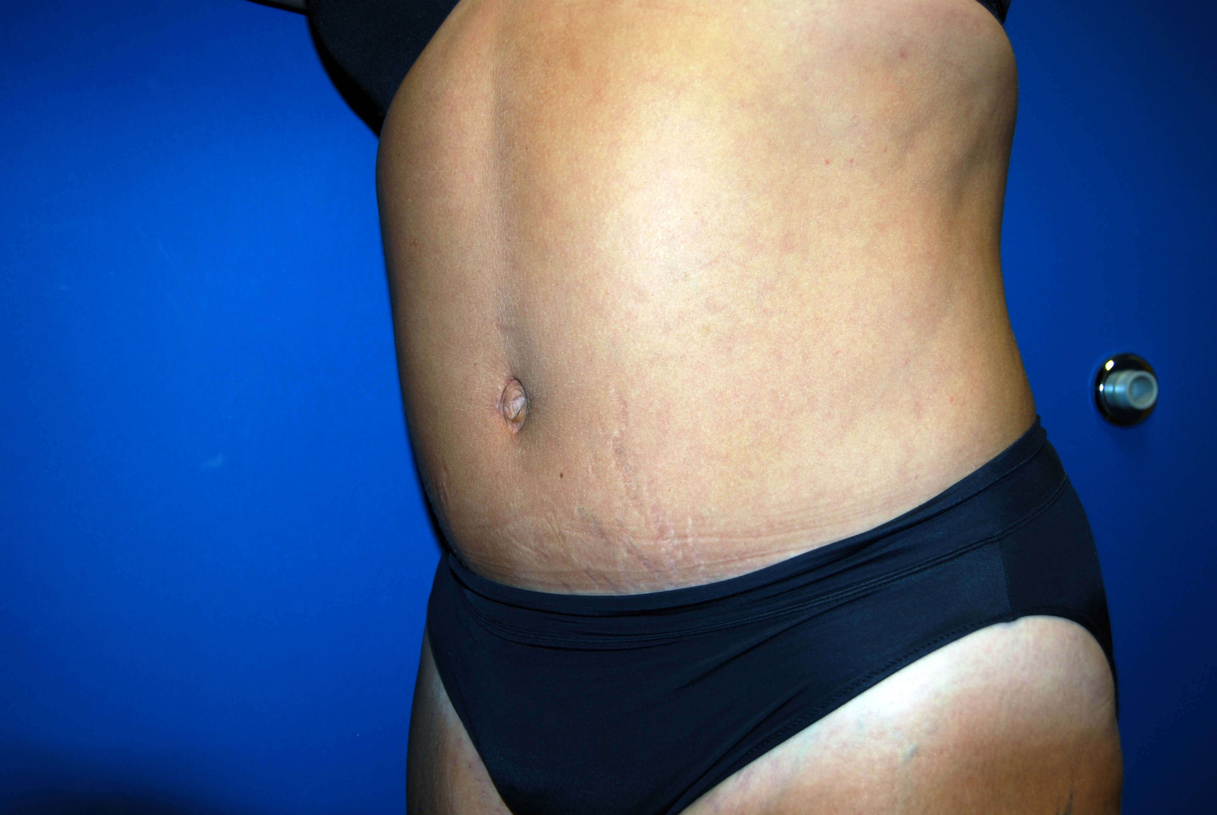 Left After Abdominoplasty
