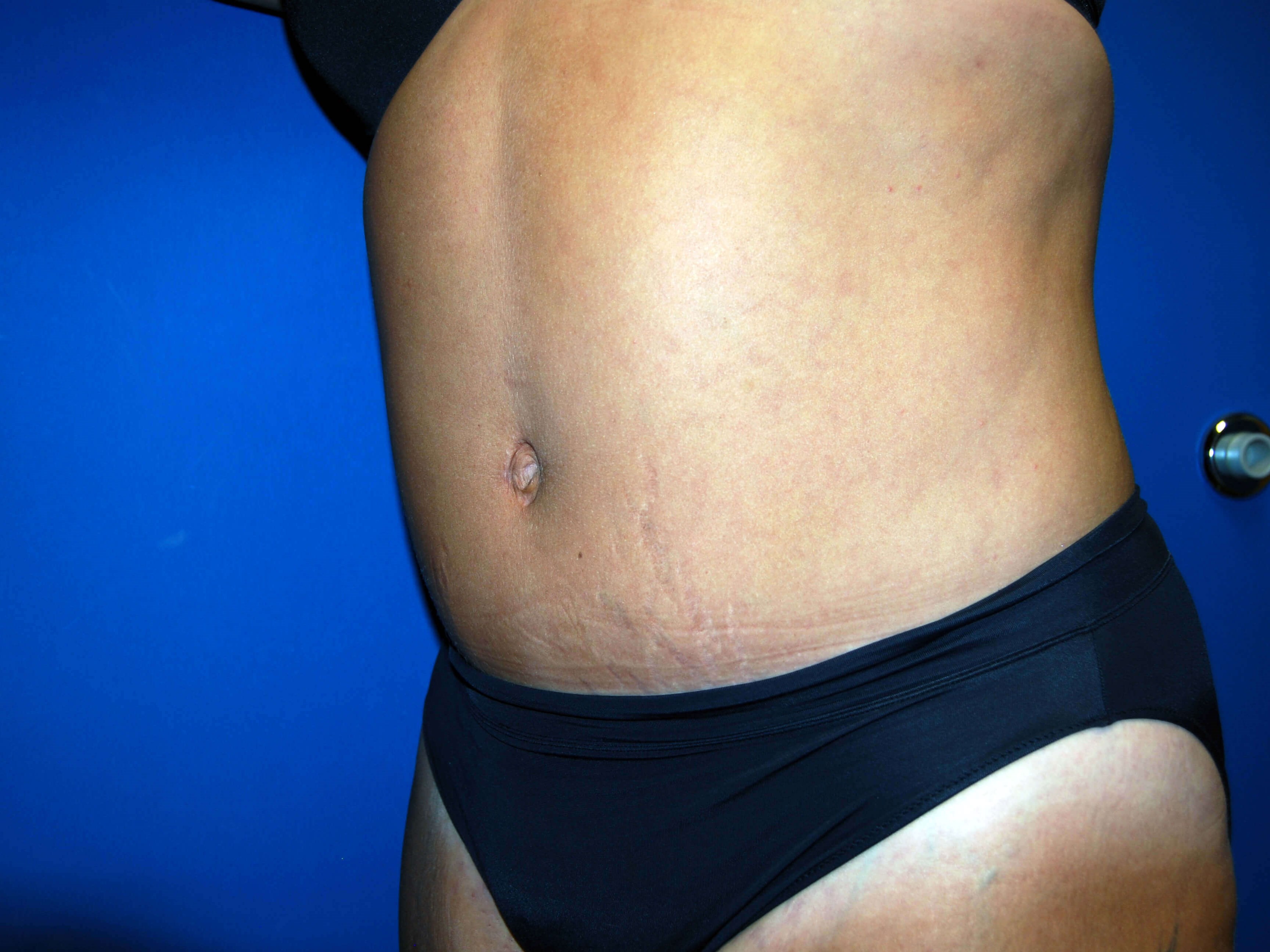 Left After Abdominoplasty