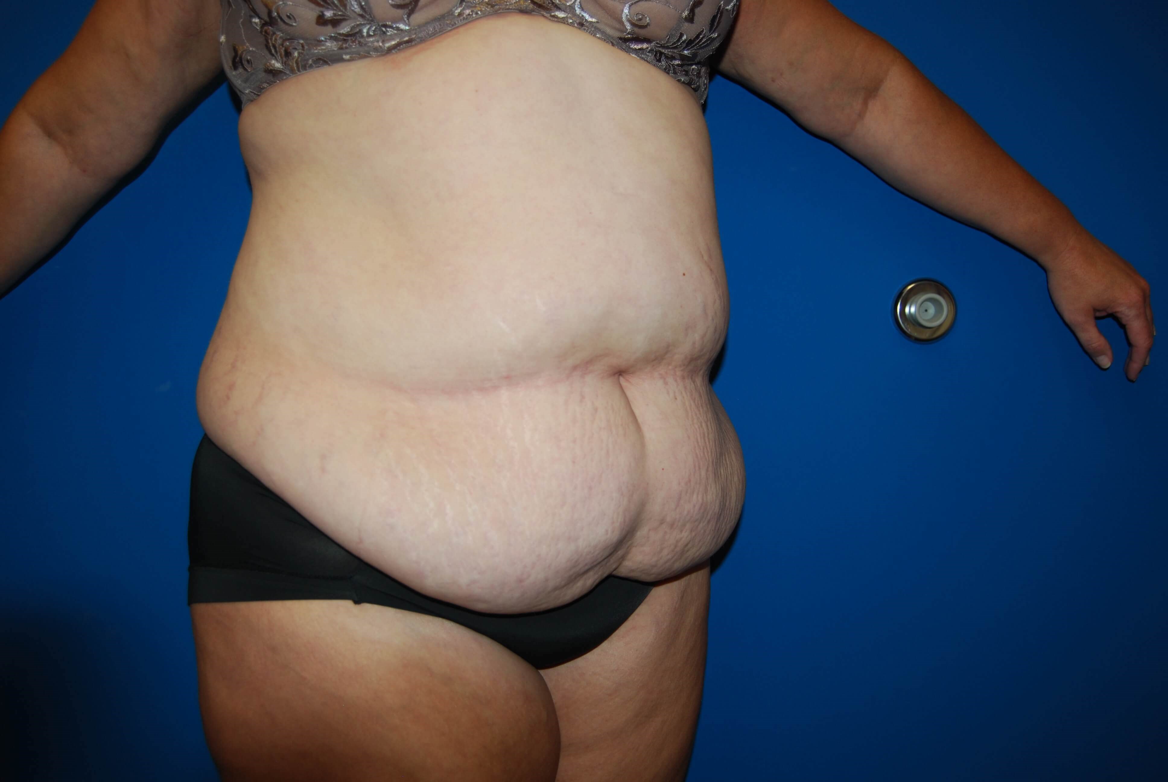 Right Before Abdominoplasty