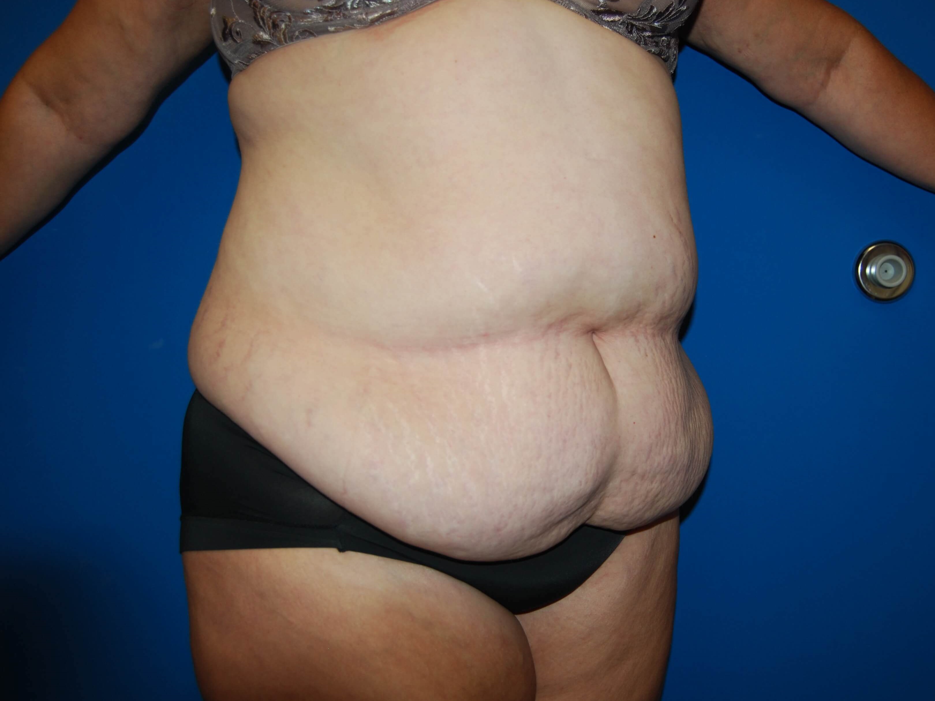 Right Before Abdominoplasty