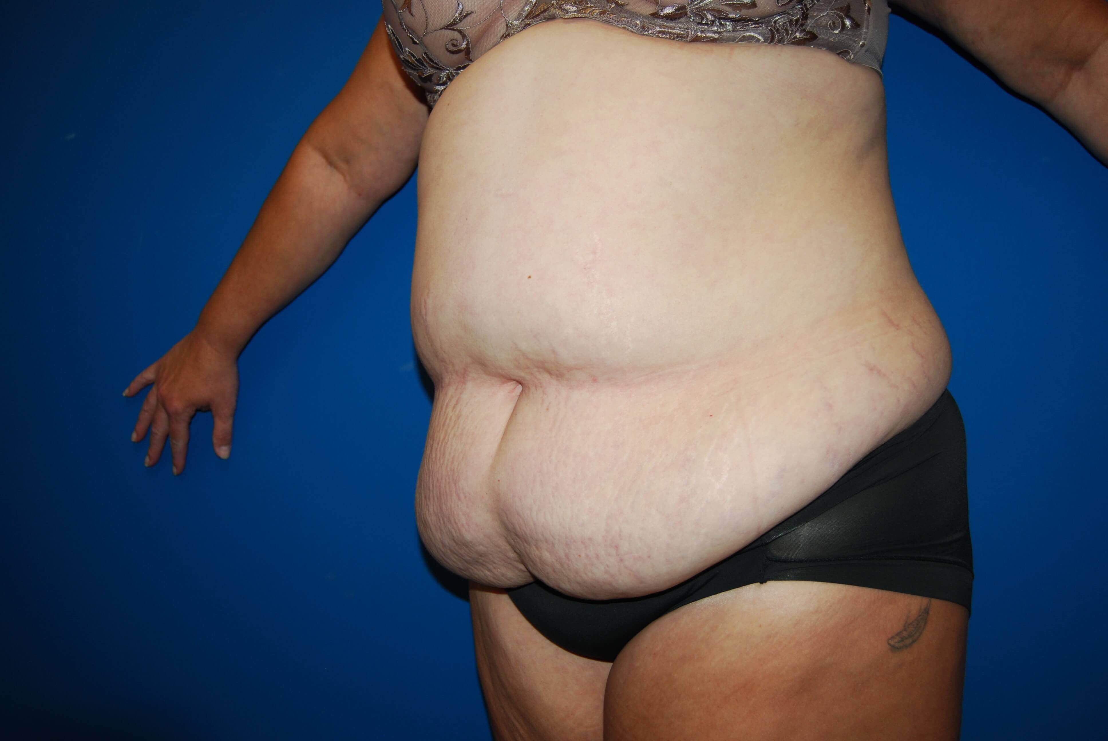 Left Before Abdominoplasty