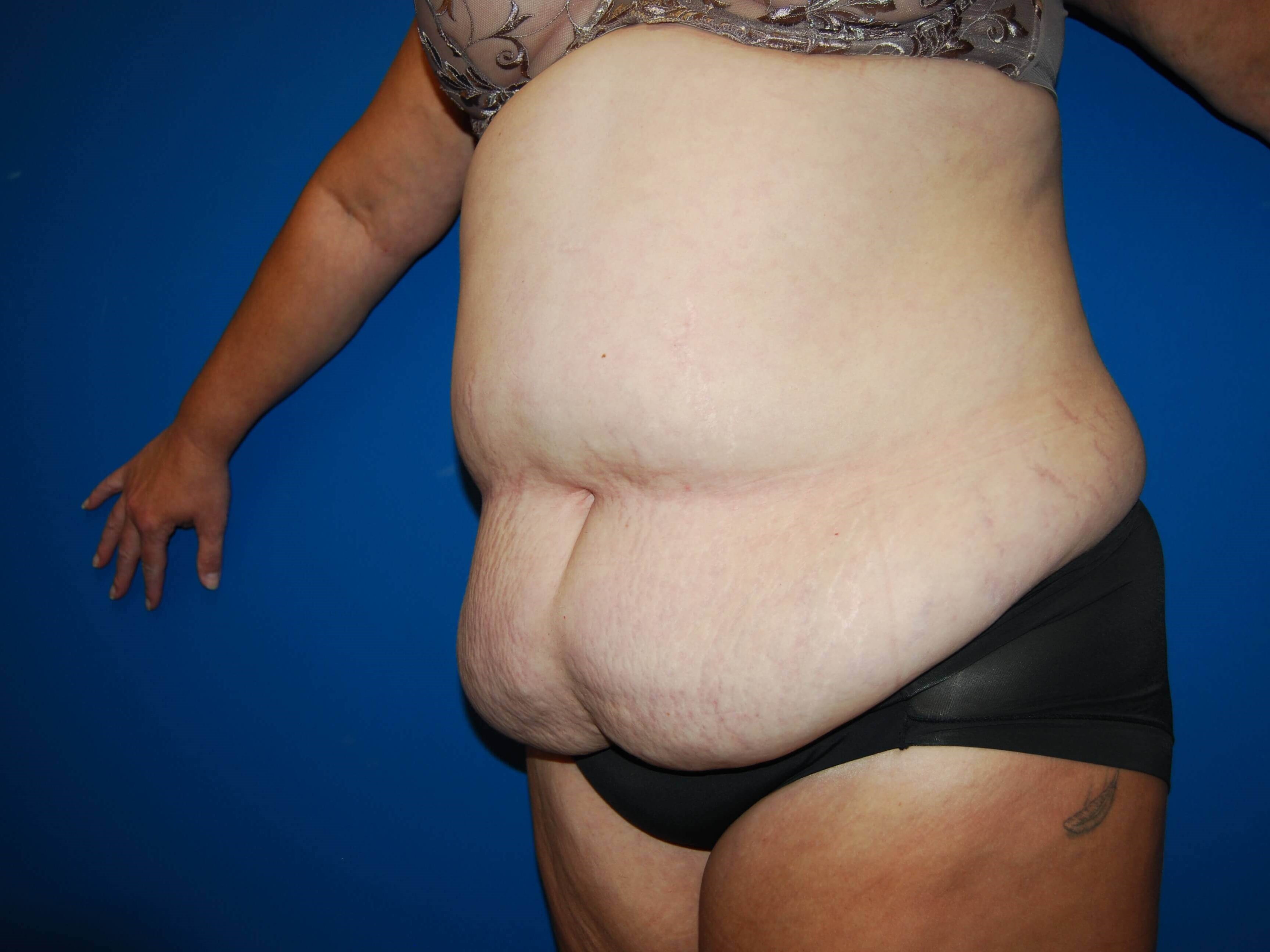 Left Before Abdominoplasty