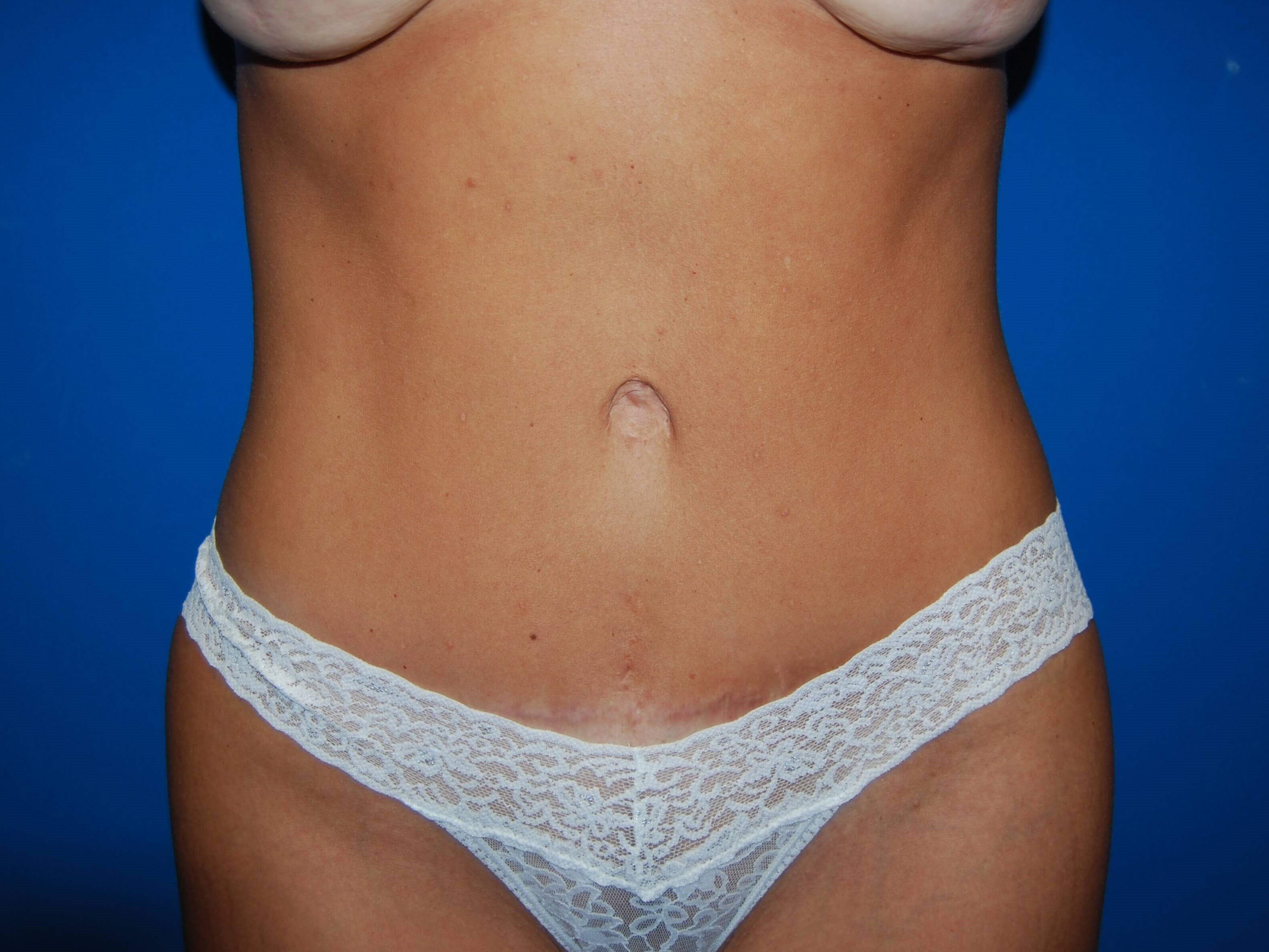 Front After