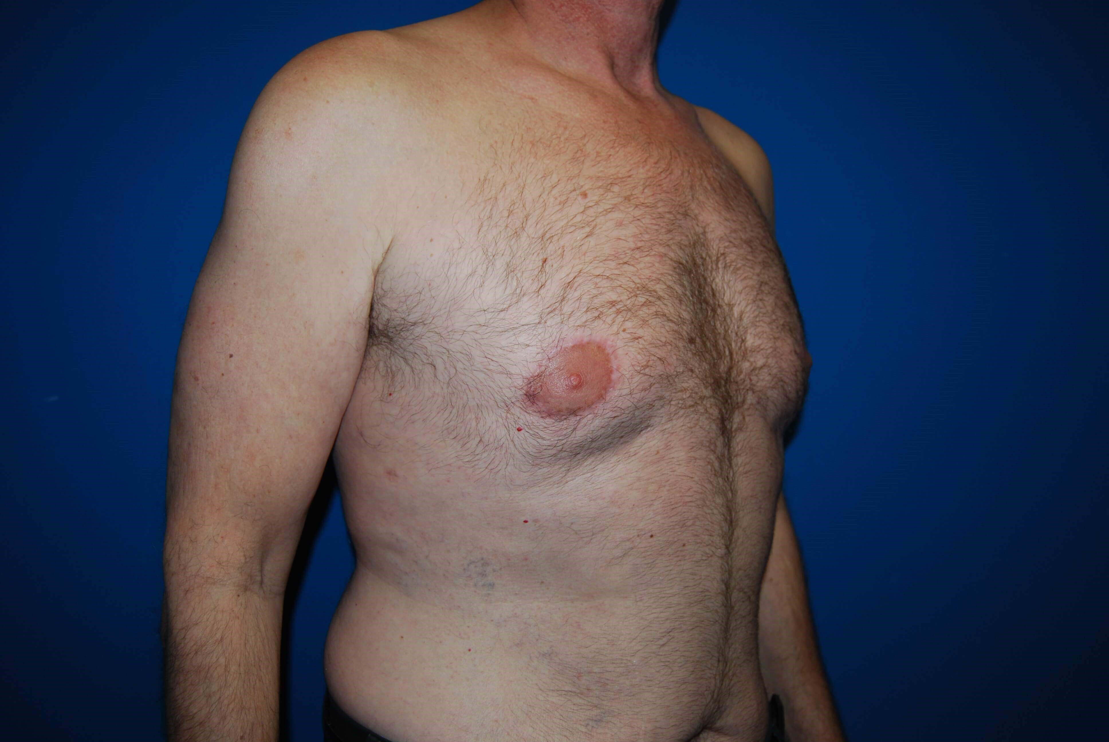Oblique-Right After