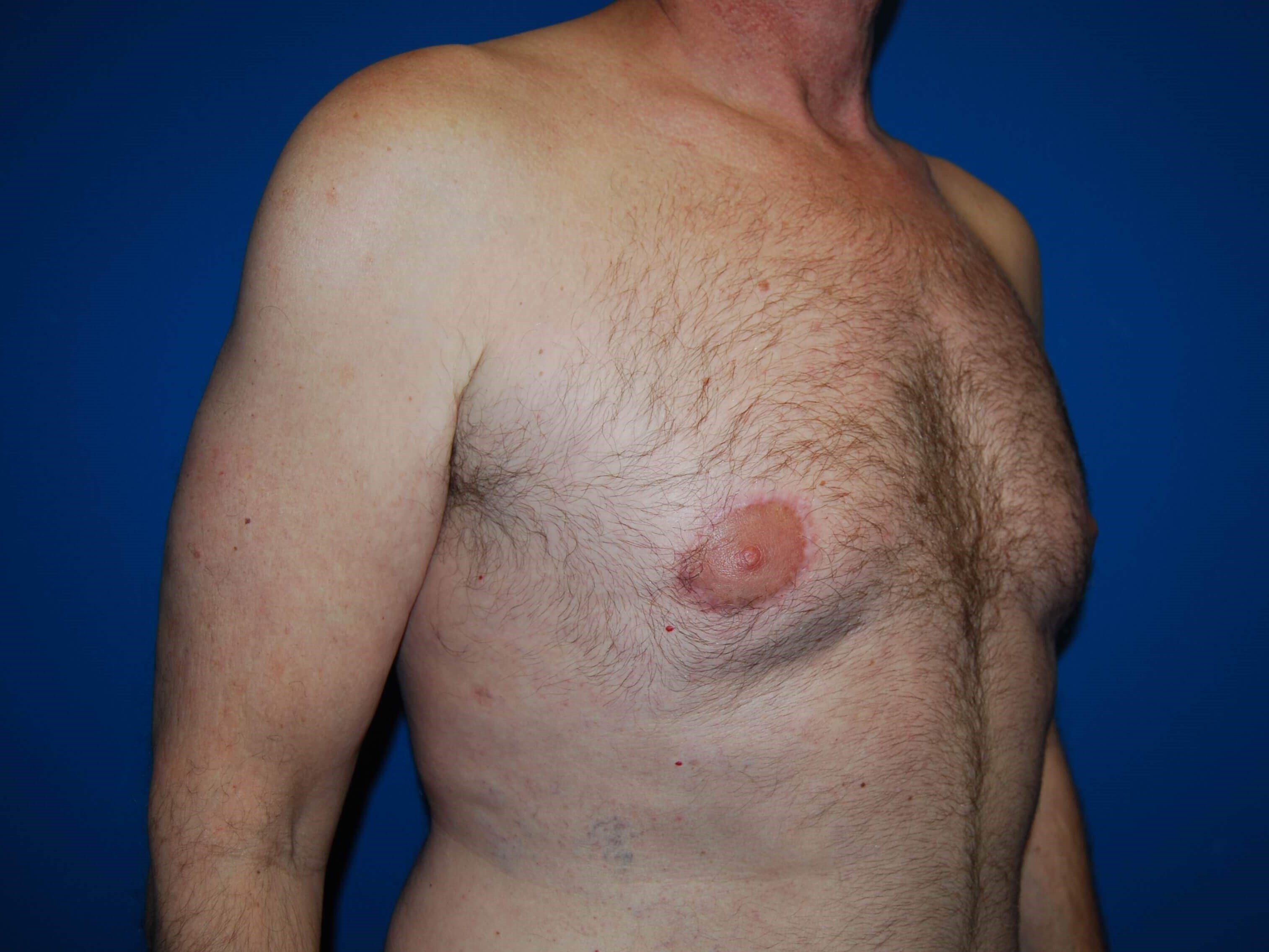 Oblique-Right After