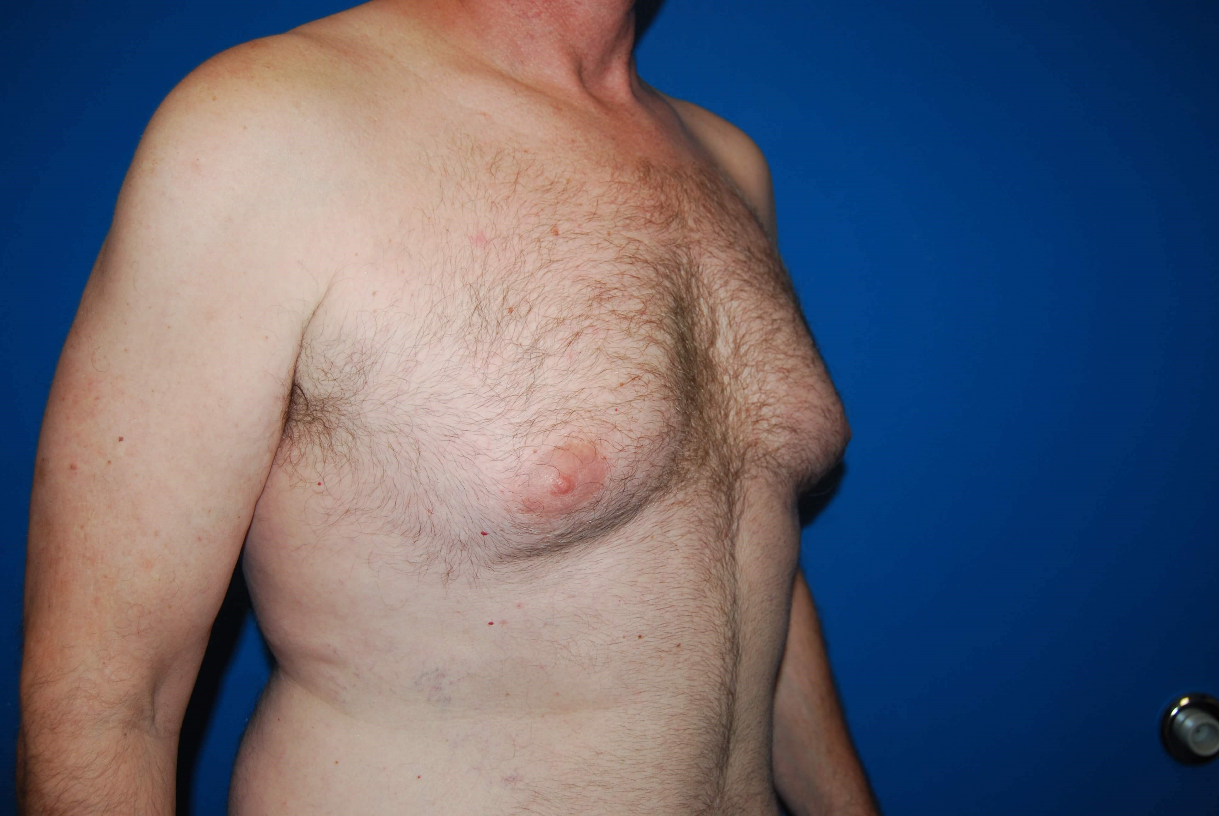 Oblique-Right Before