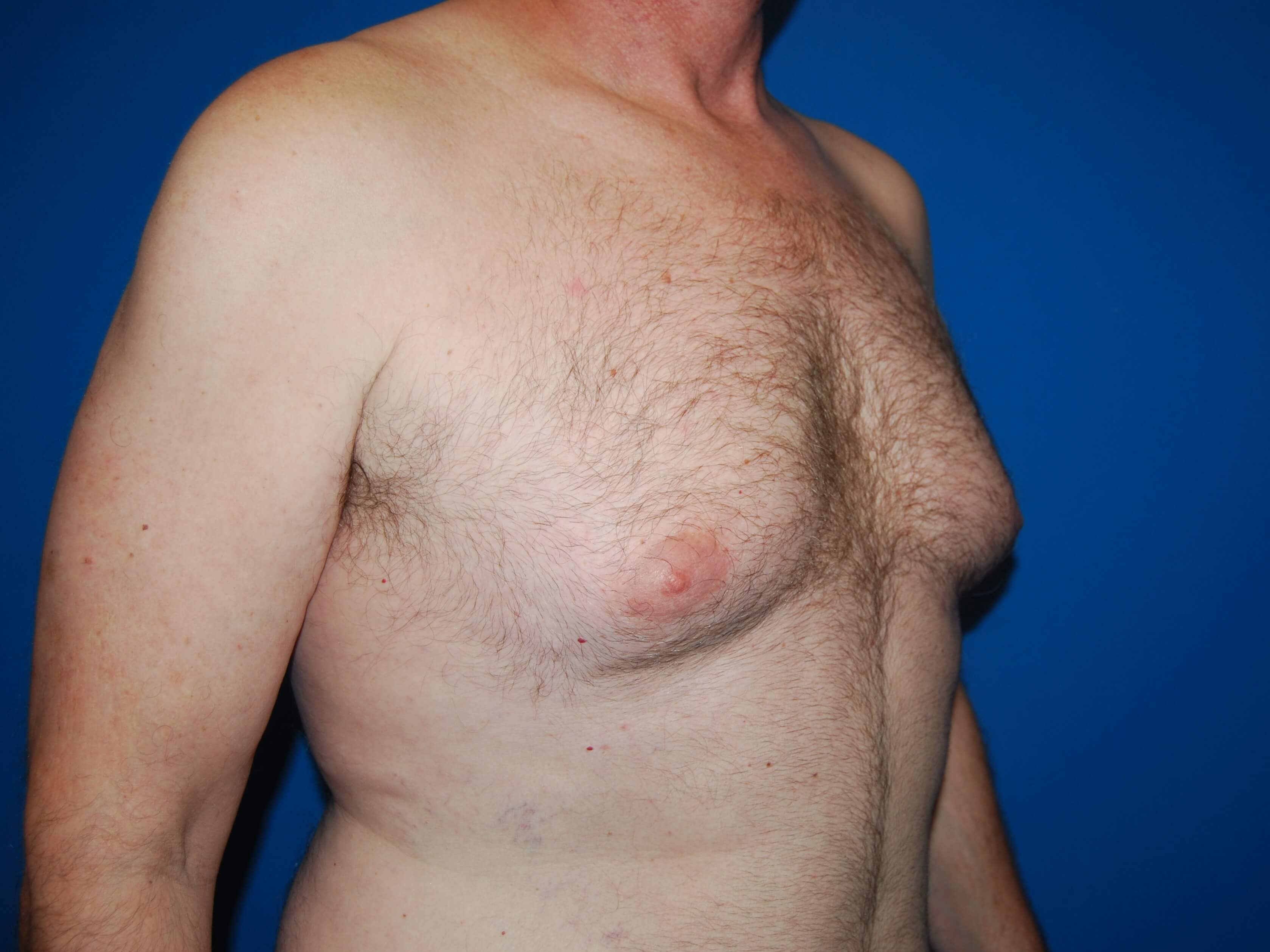 Oblique-Right Before