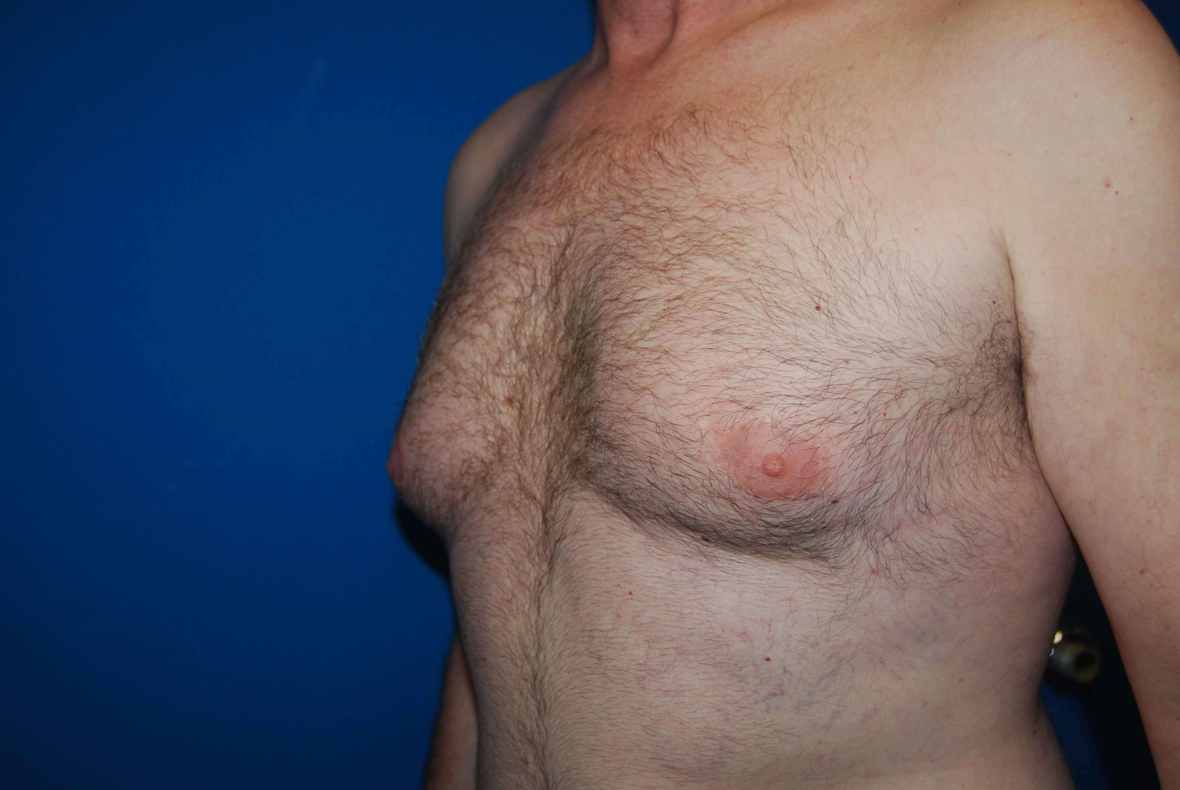 Oblique-Left Before