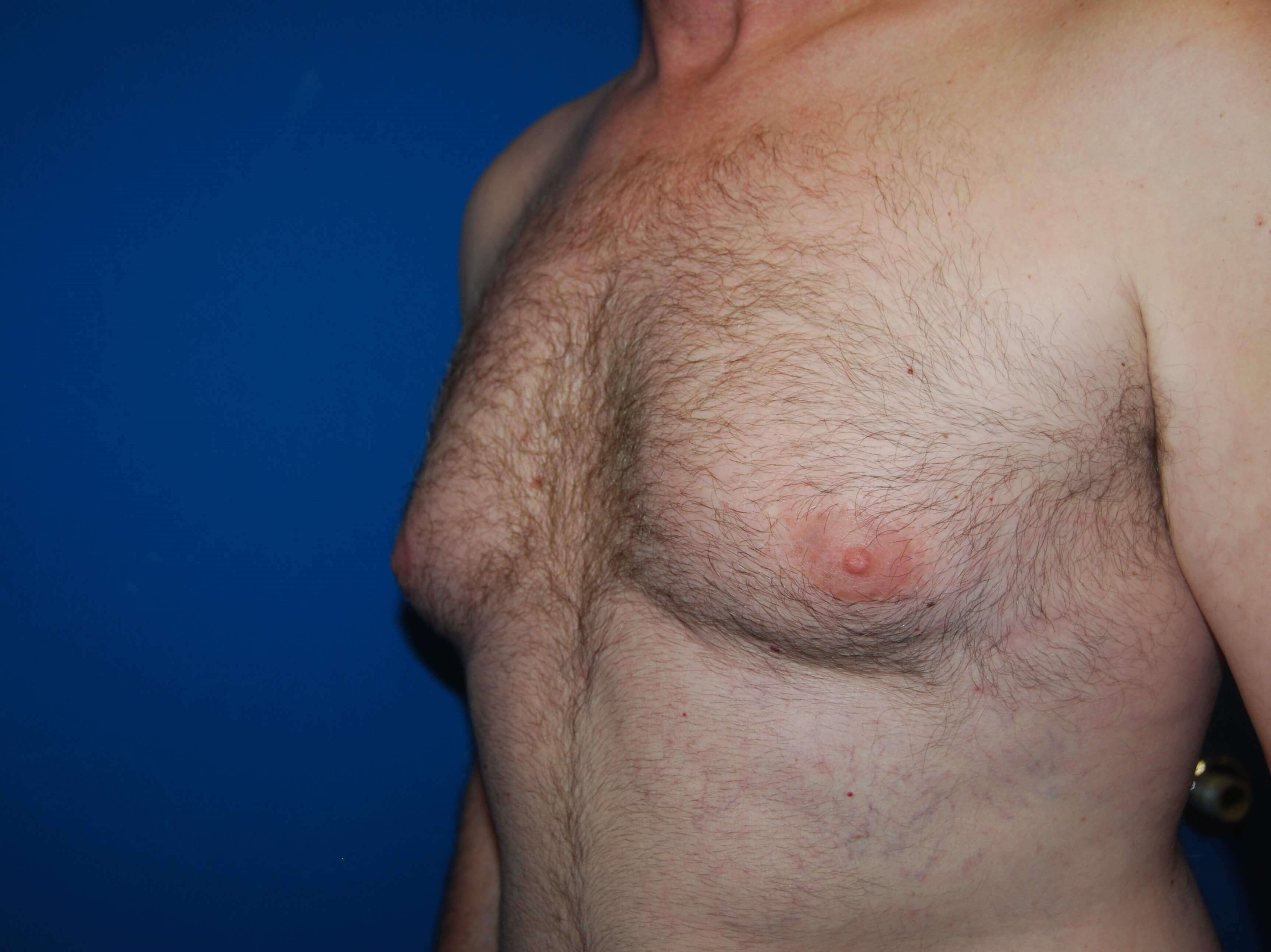 Oblique-Left Before