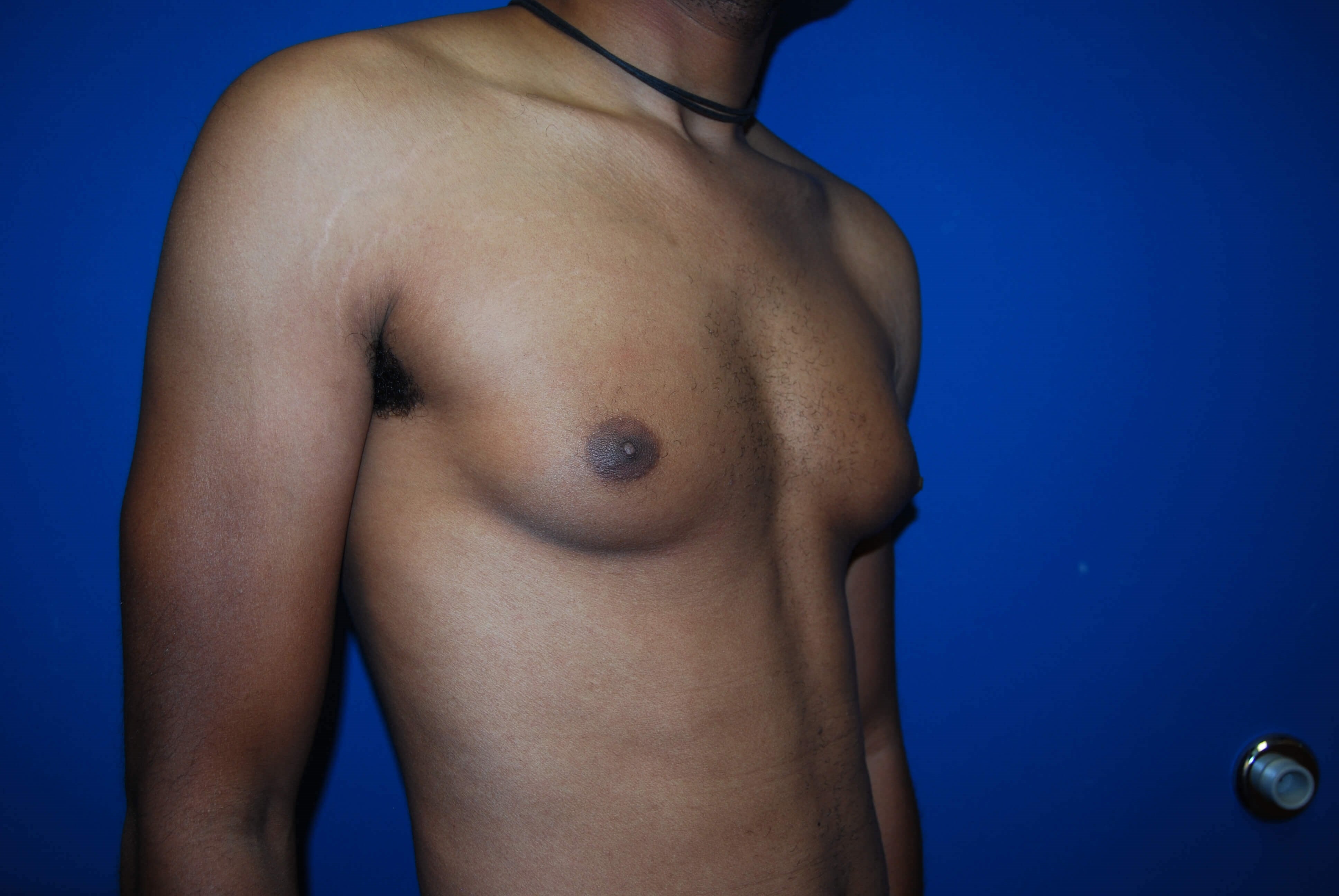 Oblique-Right Before