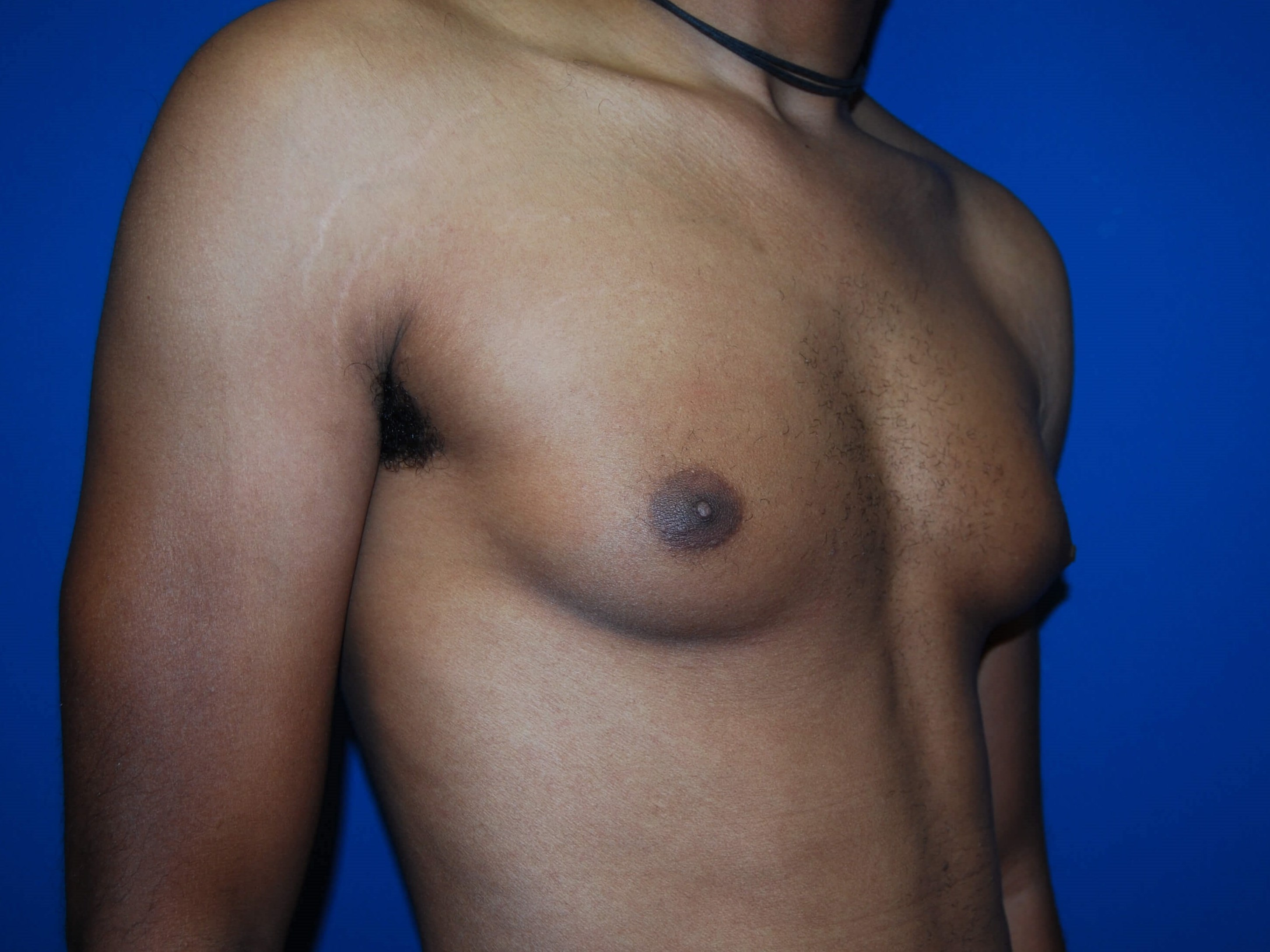 Oblique-Right Before
