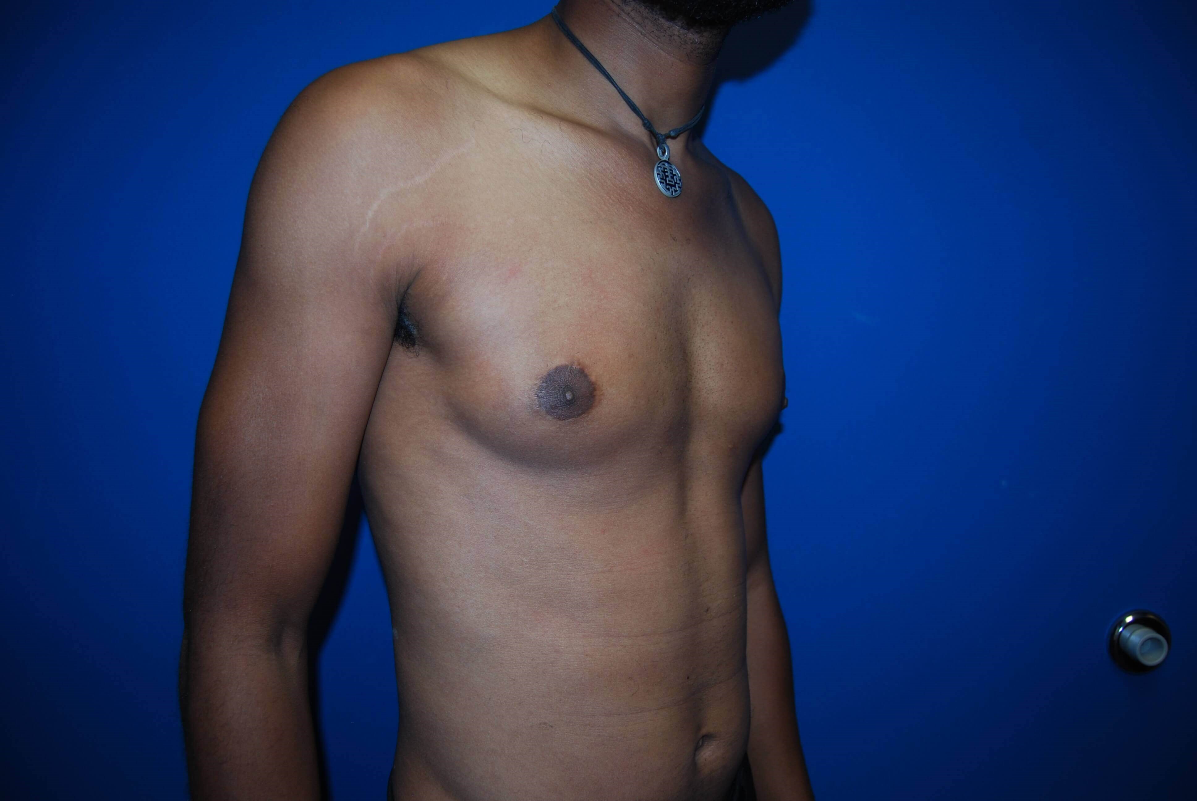 Oblique-Right After