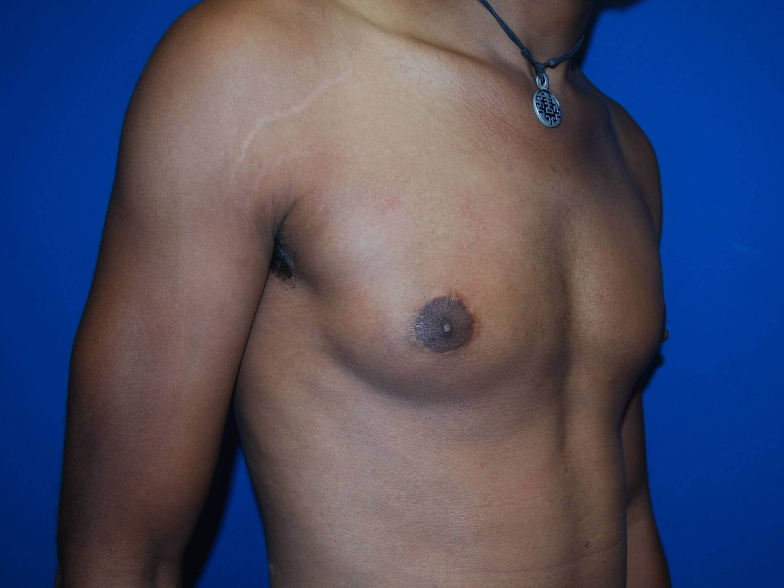 Oblique-Right After