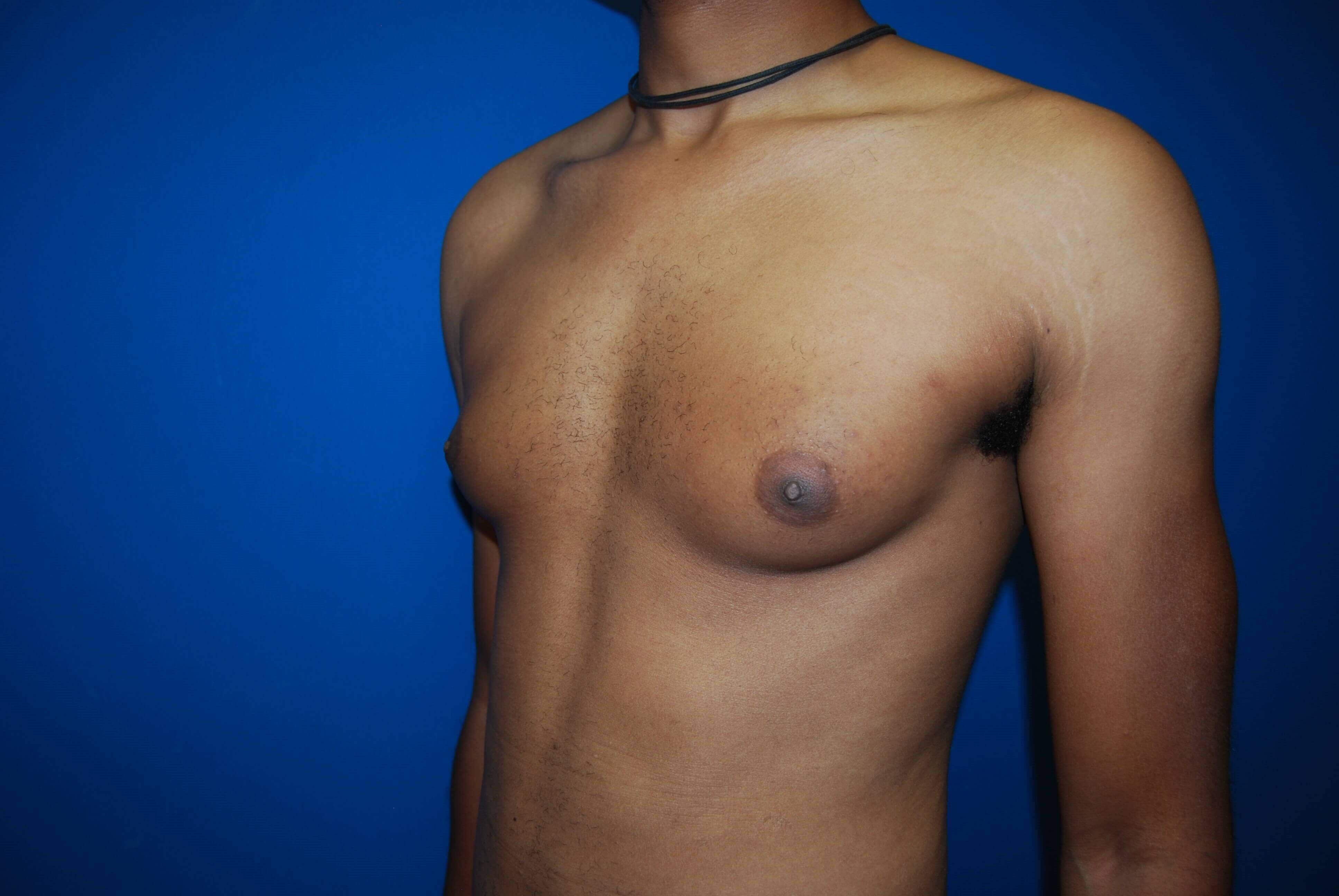 Oblique-Left Before