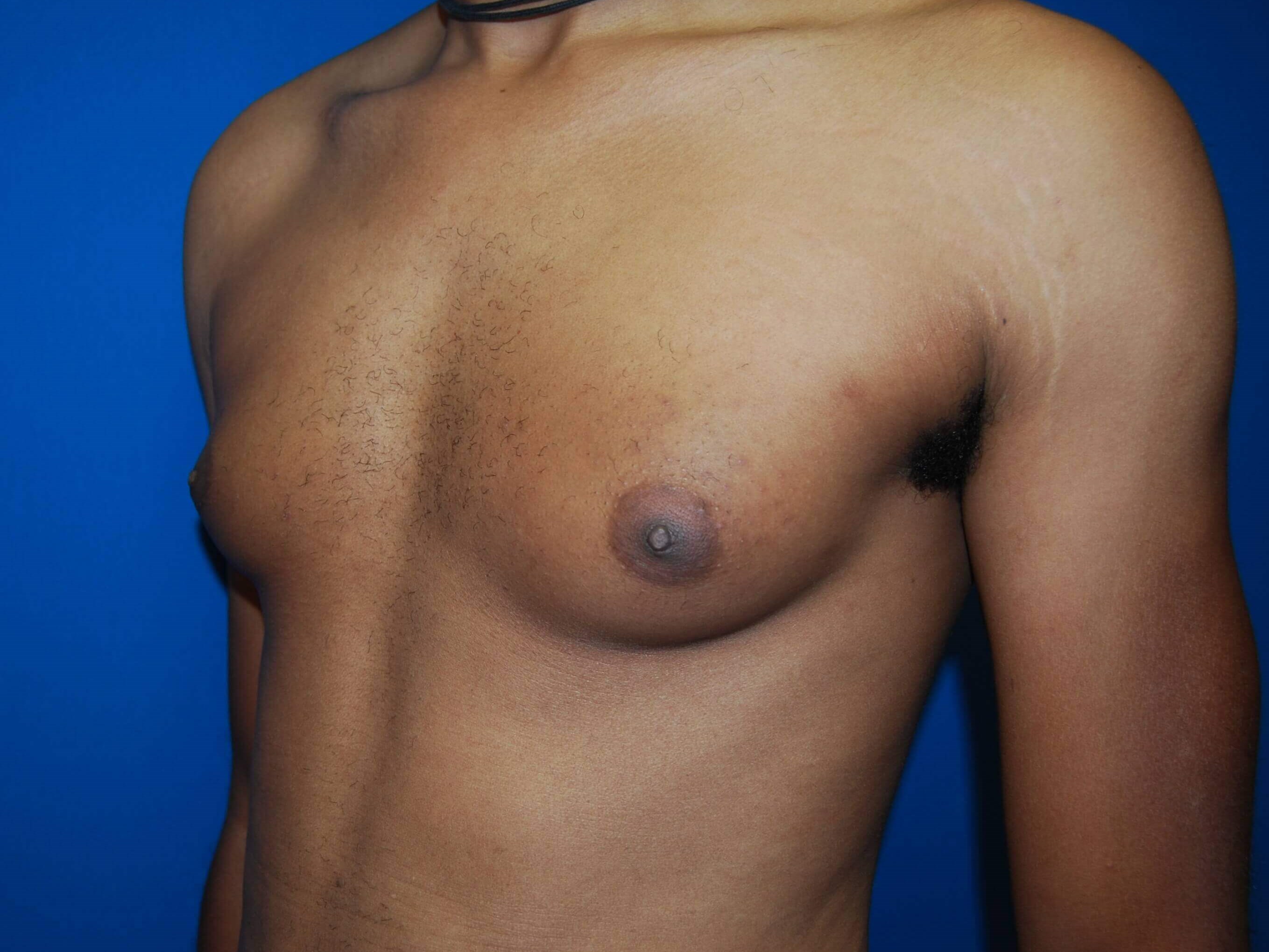 Oblique-Left Before