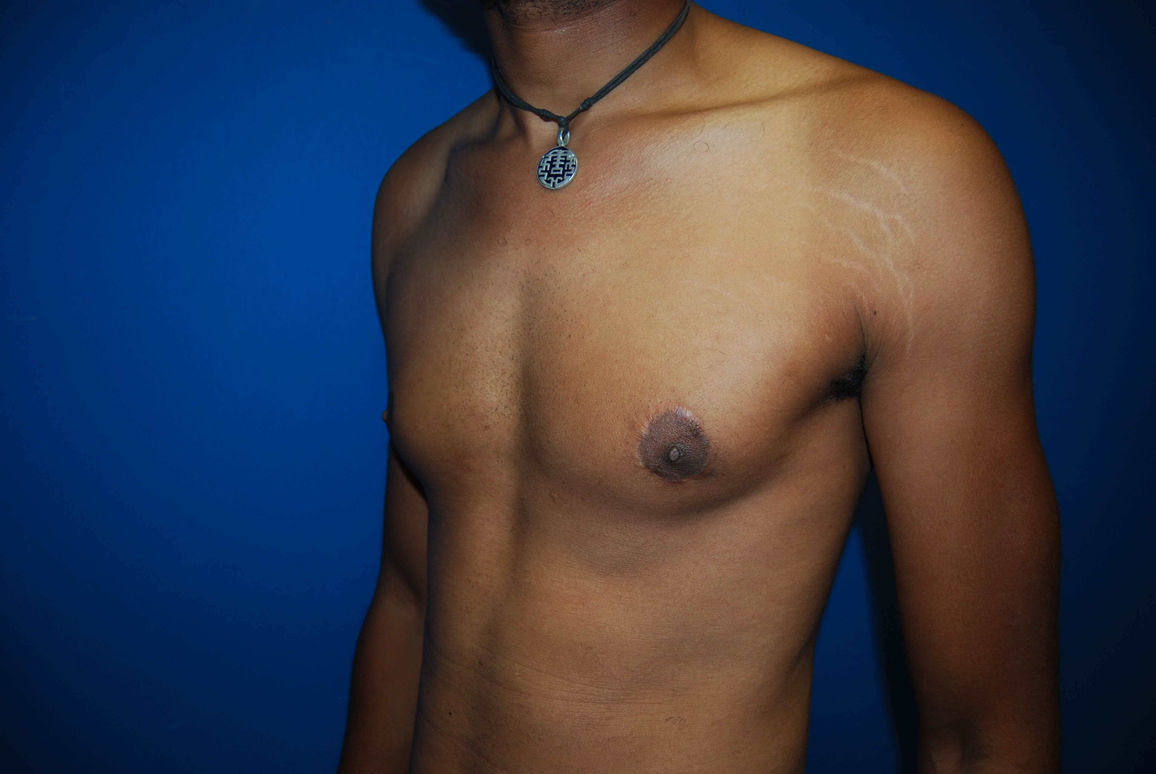 Oblique-Left After