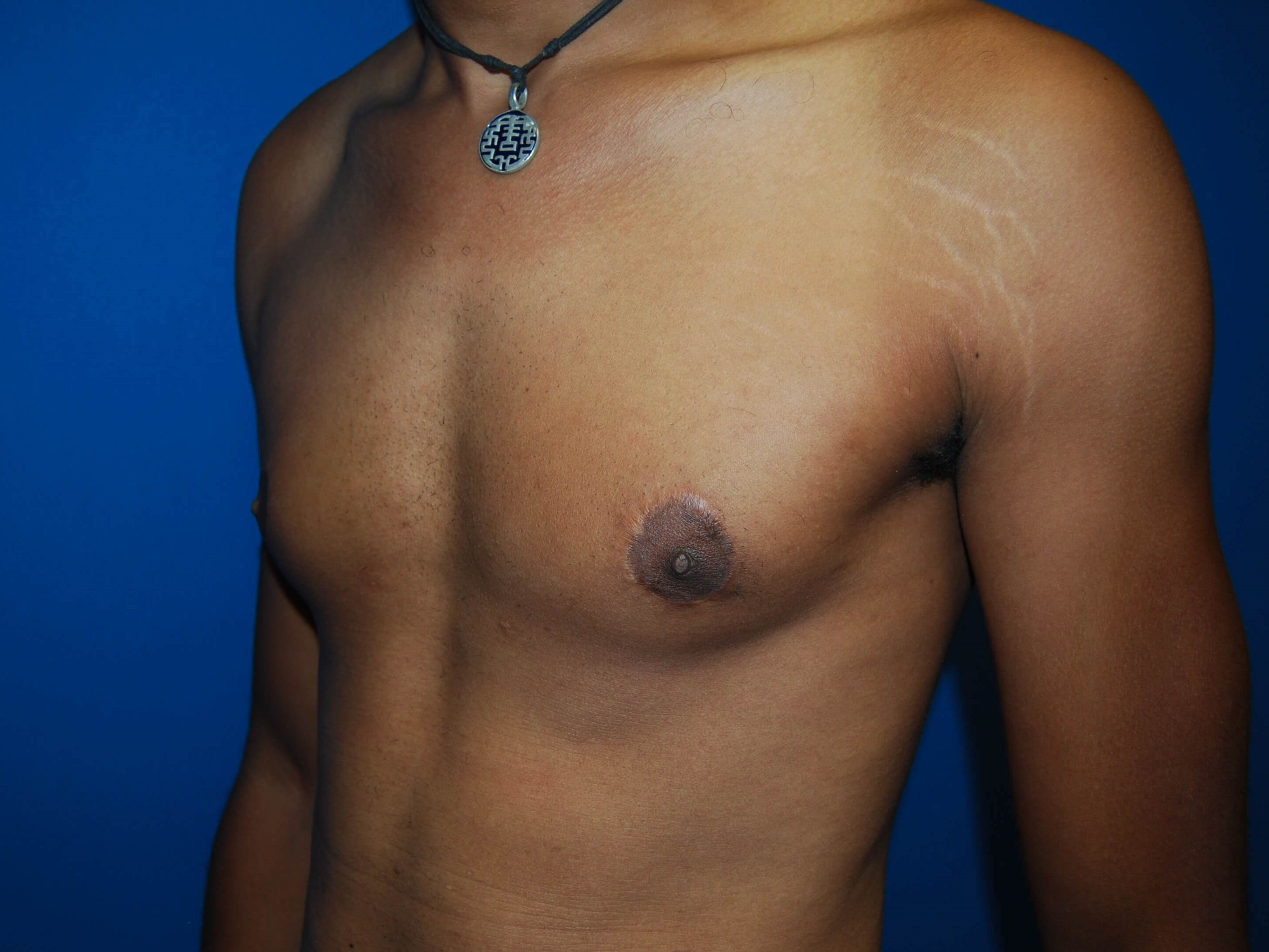 Oblique-Left After