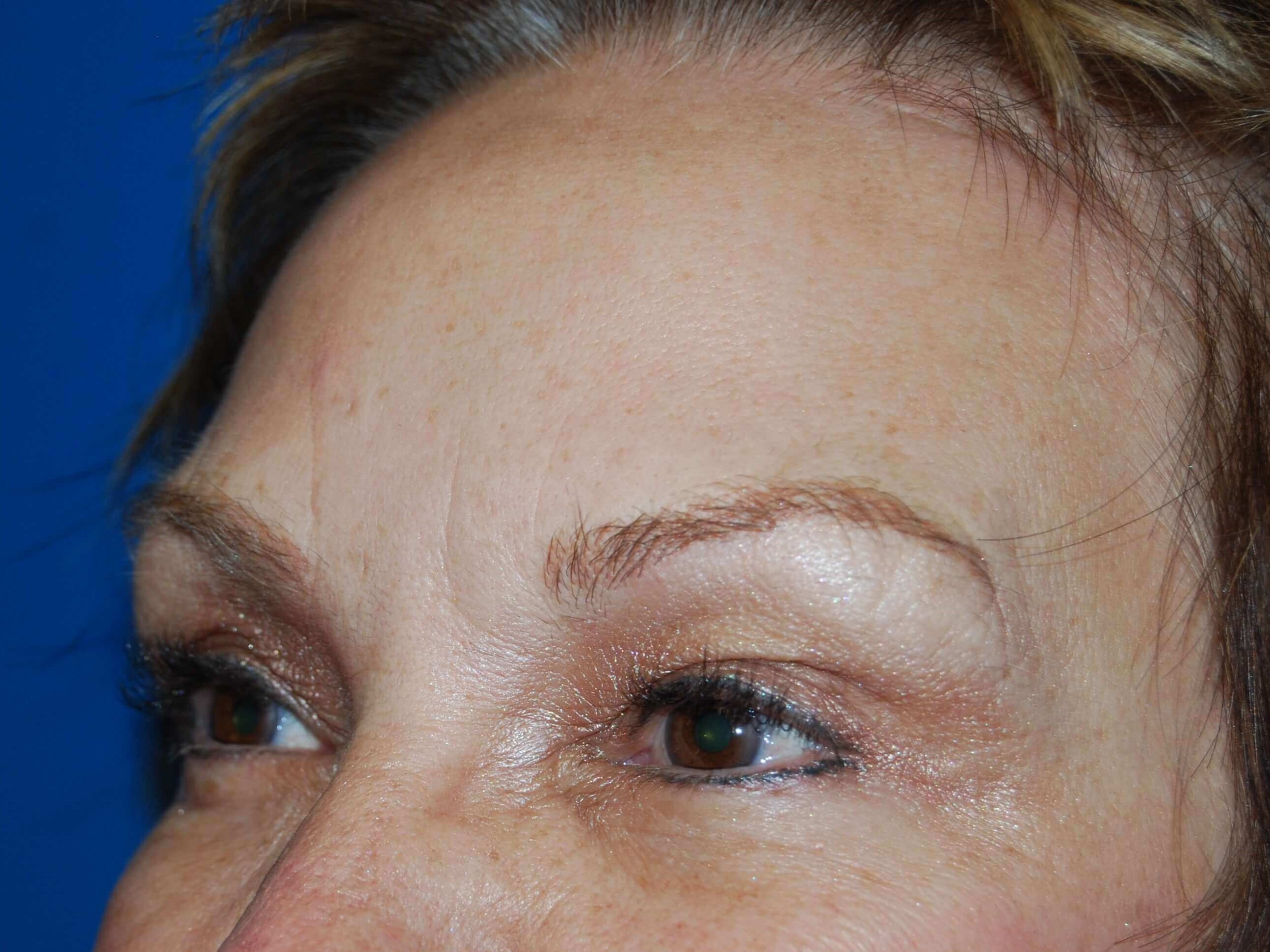 Oblique = Left Before