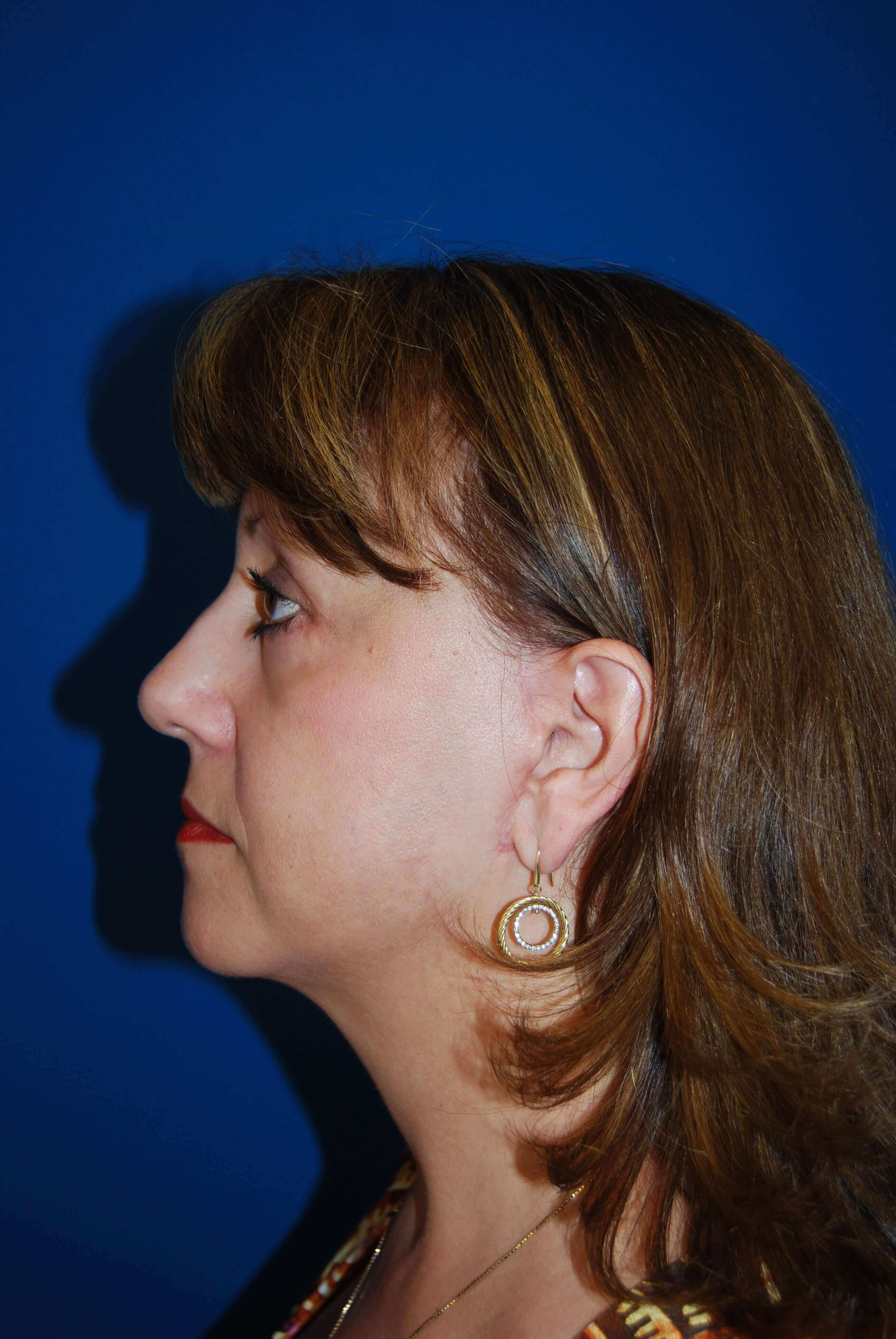 Lateral - Left After