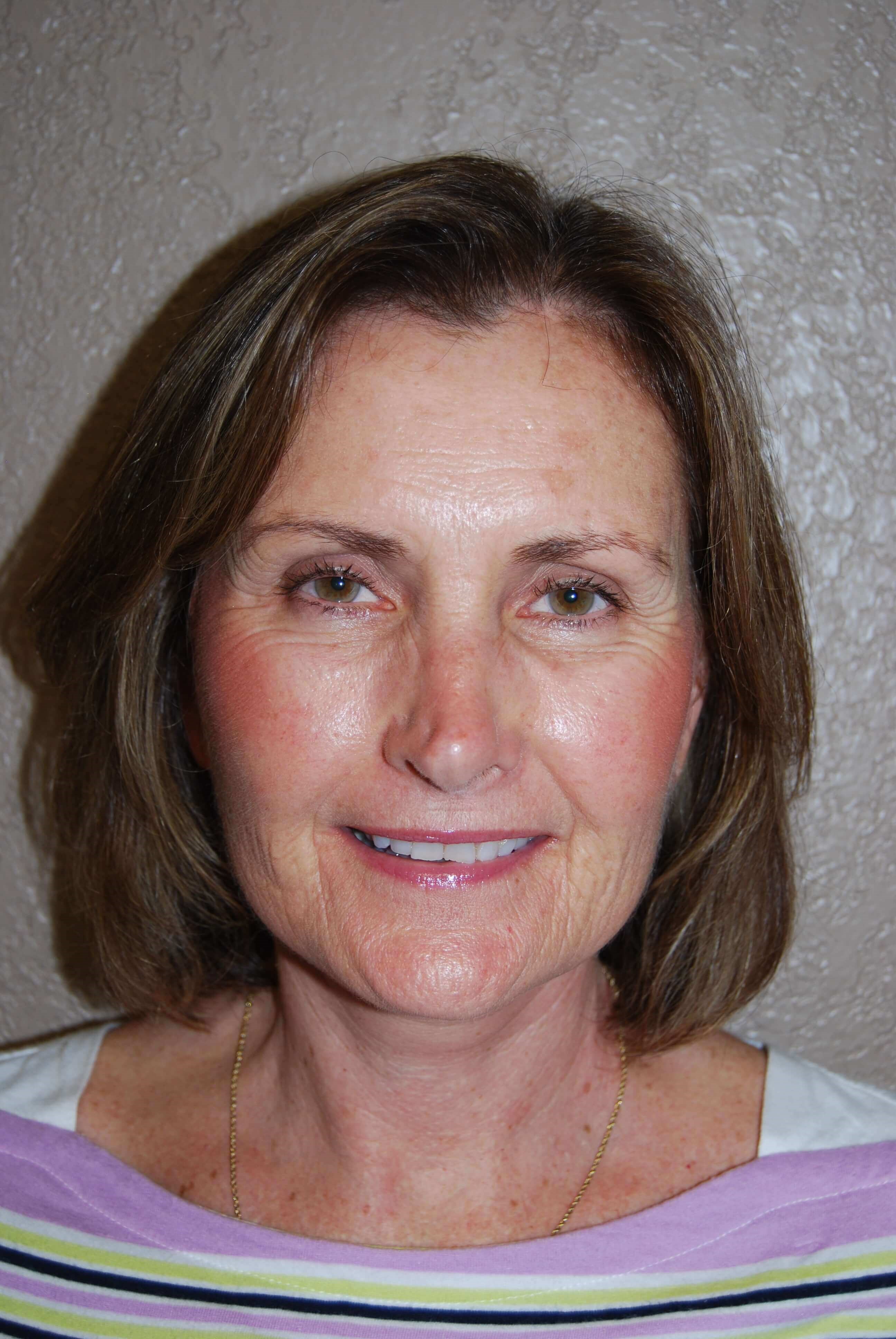 Front After Mini Face Lift