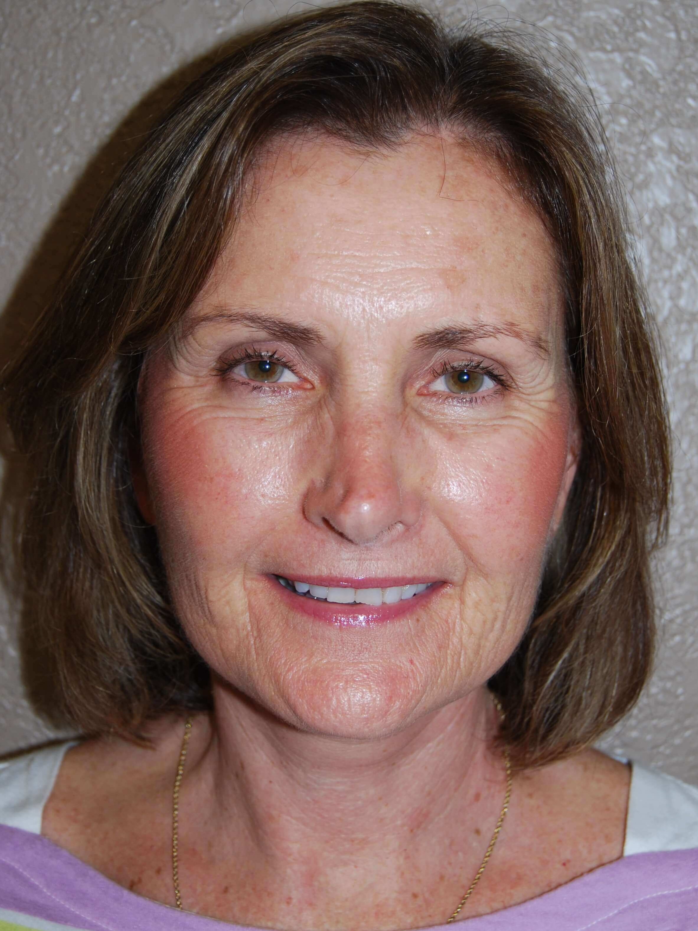 Front After Mini Face Lift
