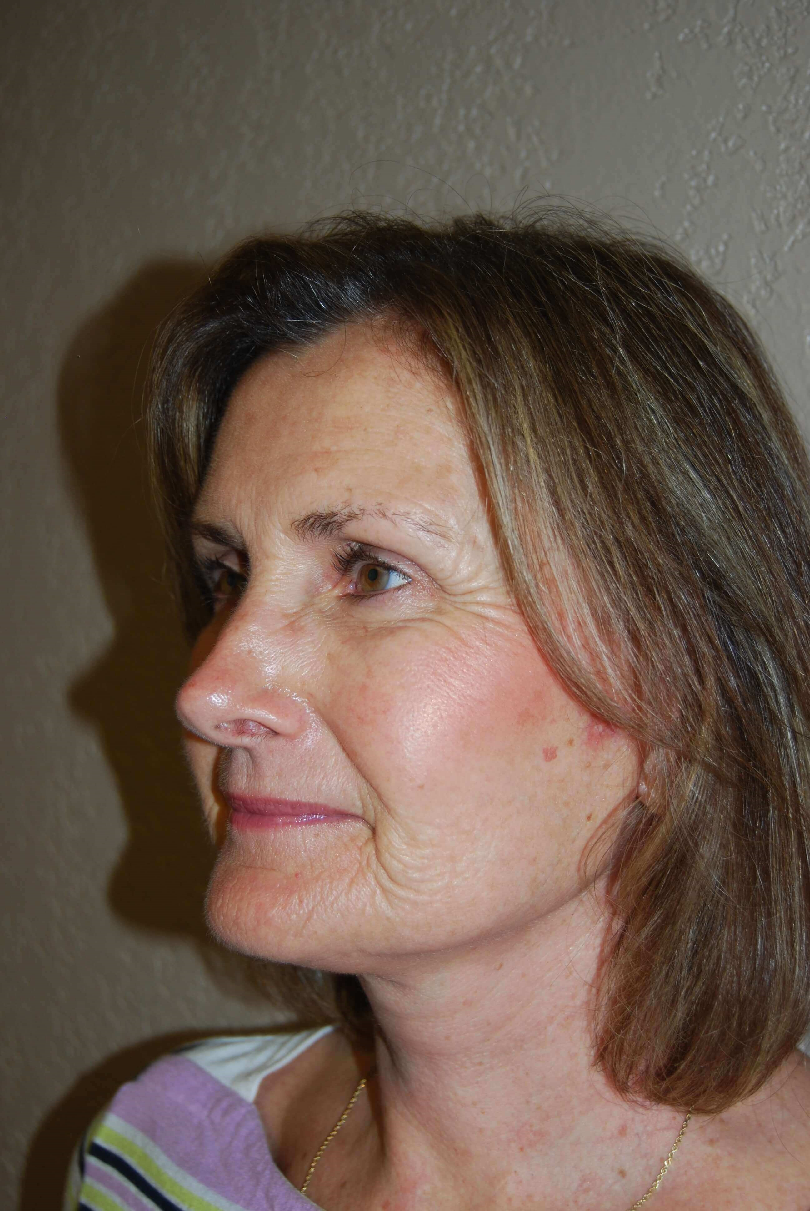 Oblique - Left After Mini Face Lift