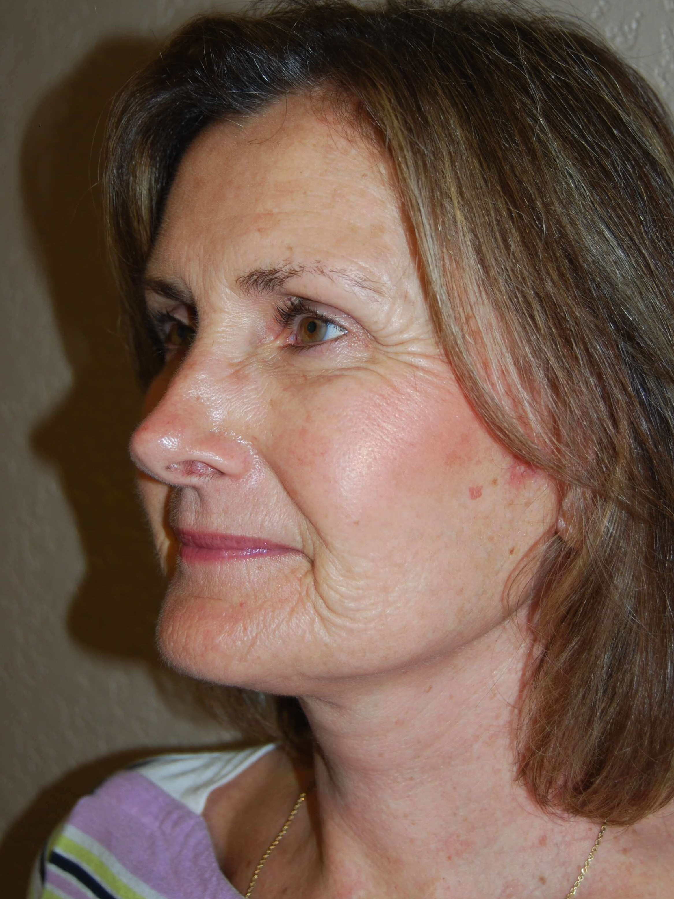 Oblique - Left After Mini Face Lift