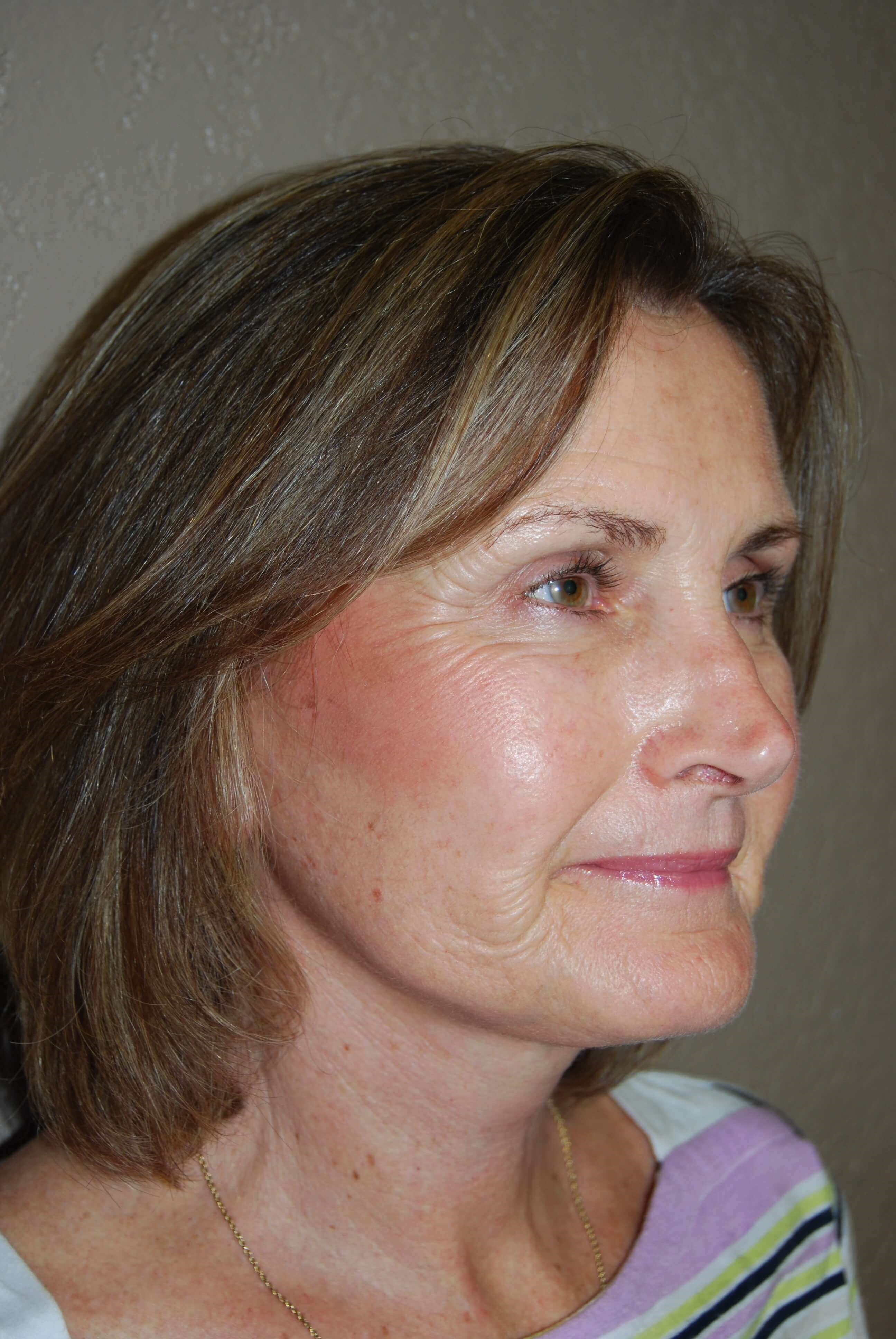 Oblique - Right After Mini Face Lift