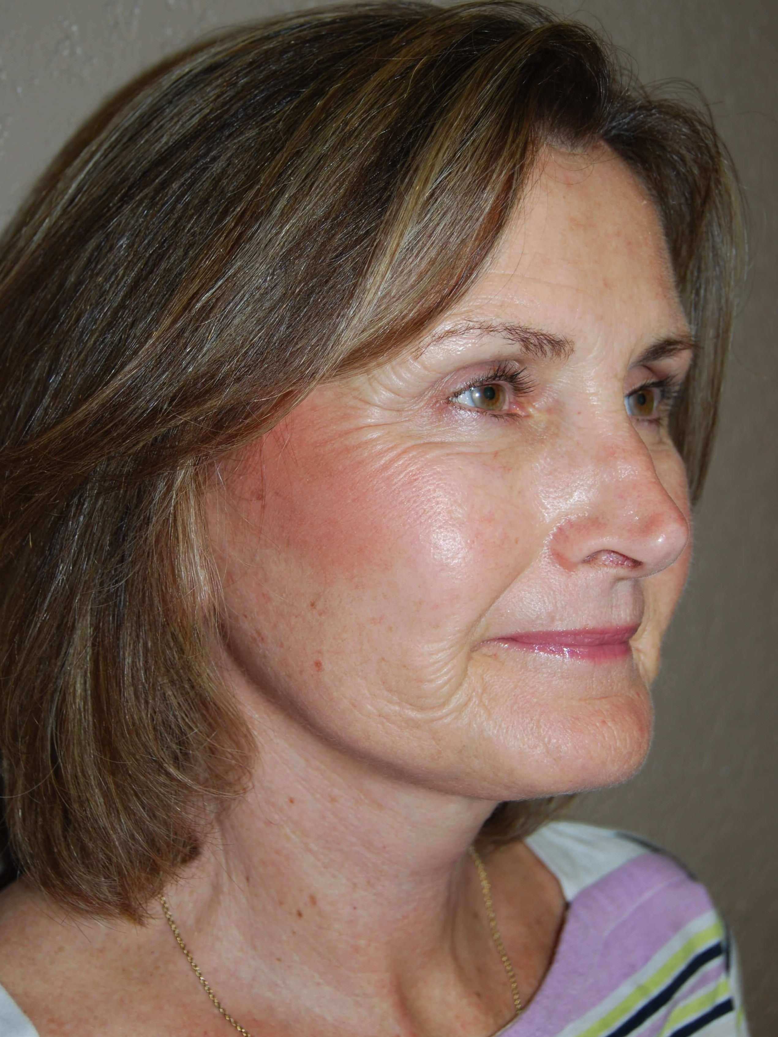Oblique - Right After Mini Face Lift
