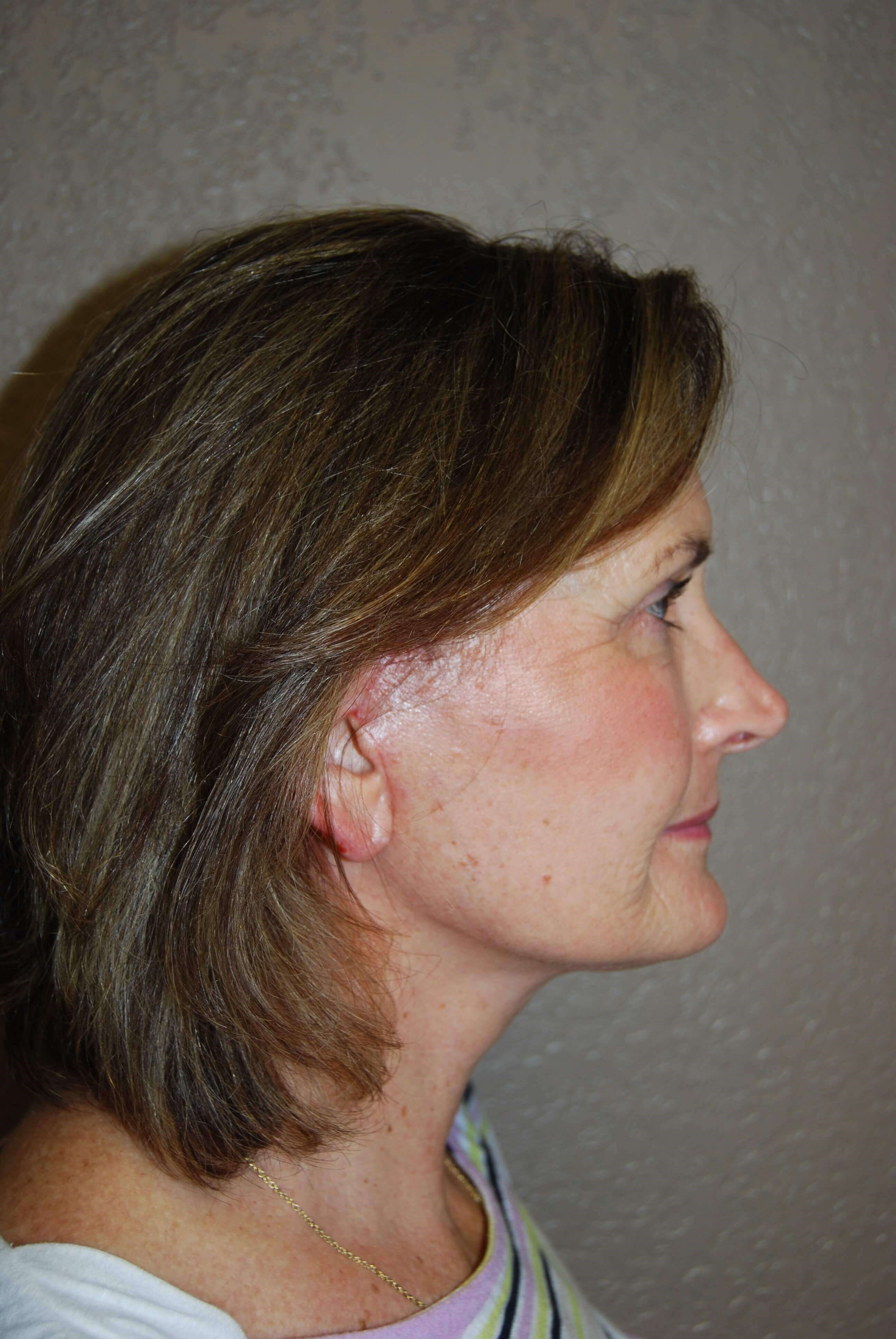 Lateral - Right After Mini Face Lift
