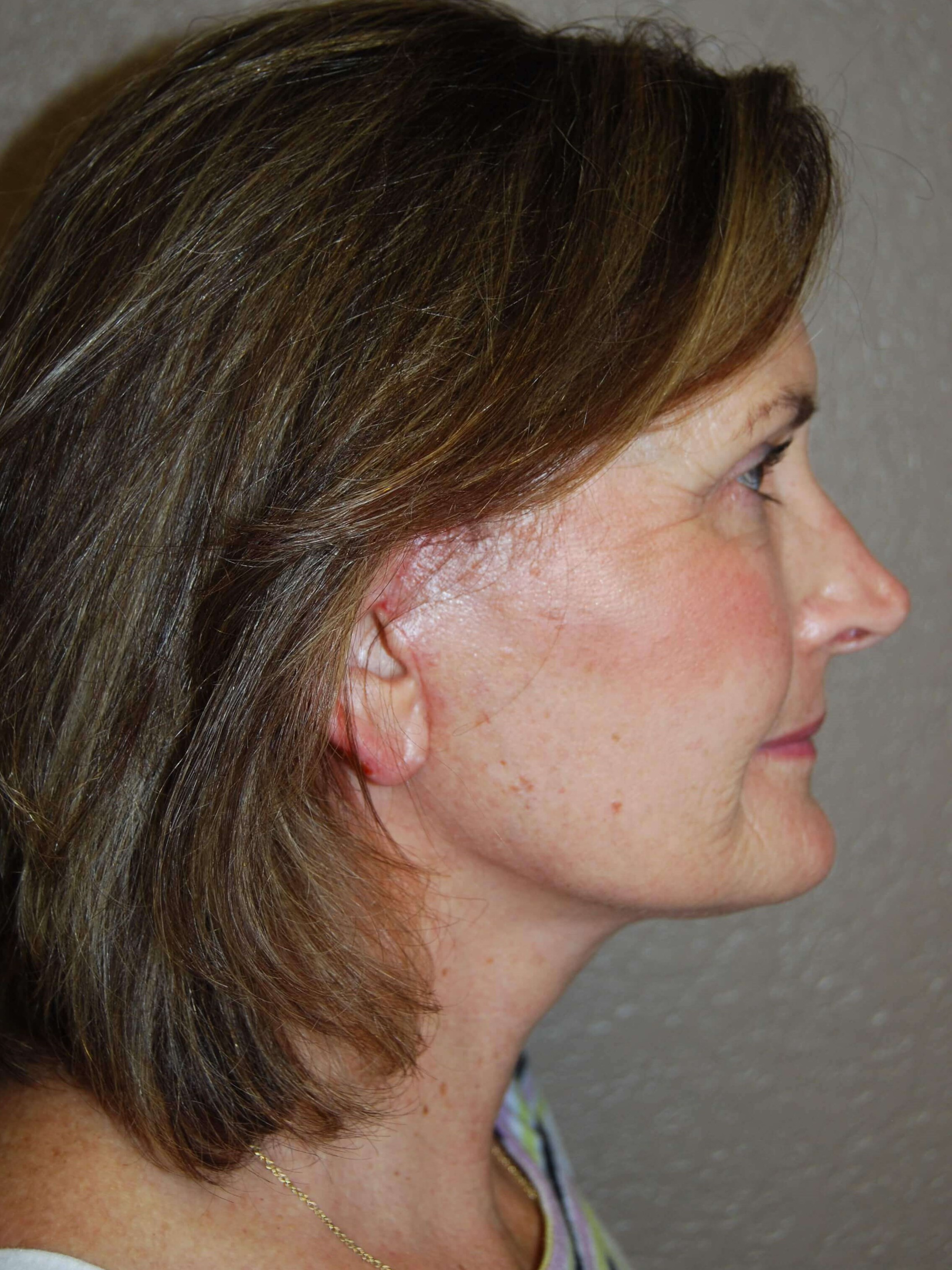 Lateral - Right After Mini Face Lift